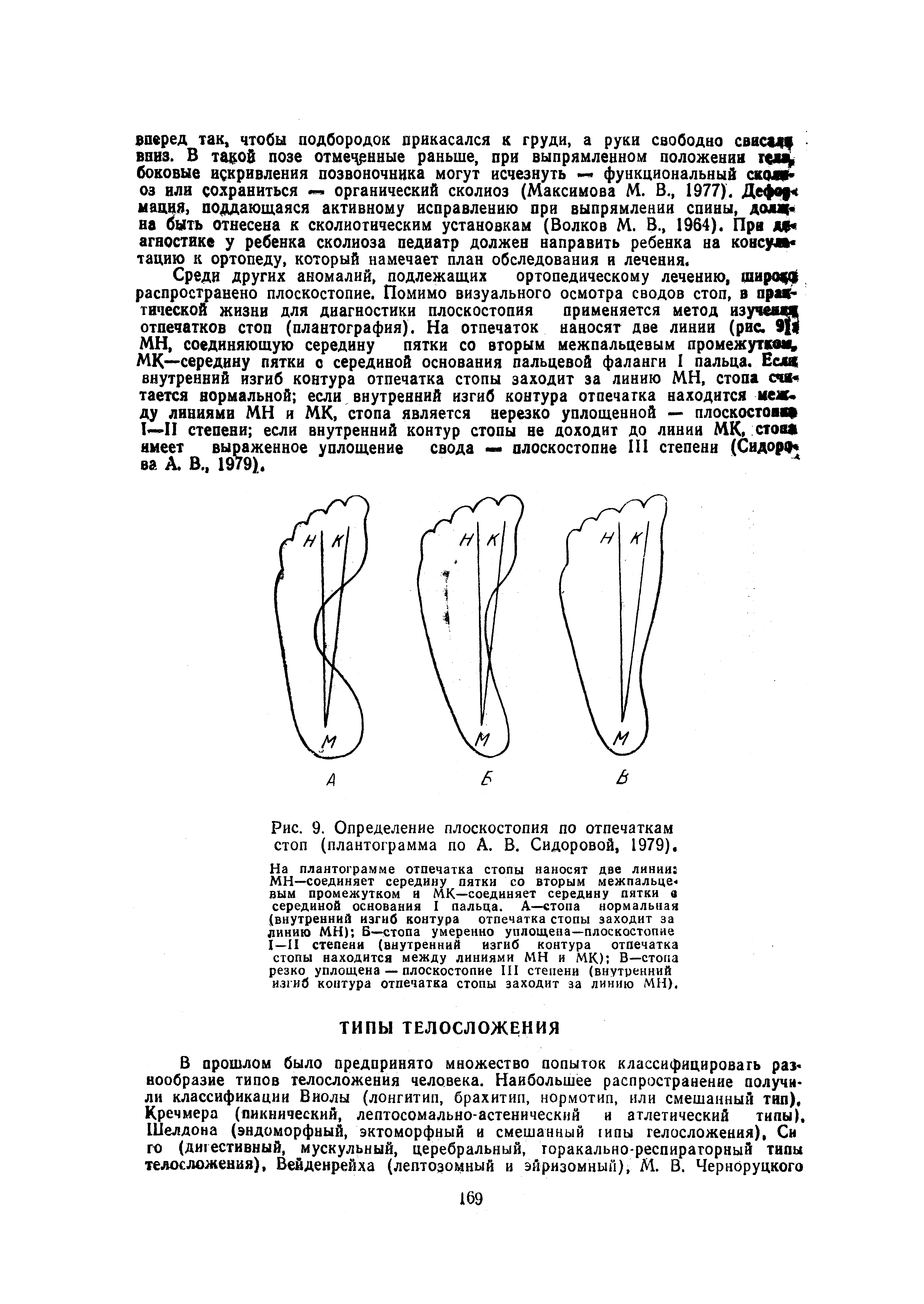 Рис. 9. Определение плоскостопия по отпечаткам стоп (плантограмма по А. В. Сидоровой, 1979).