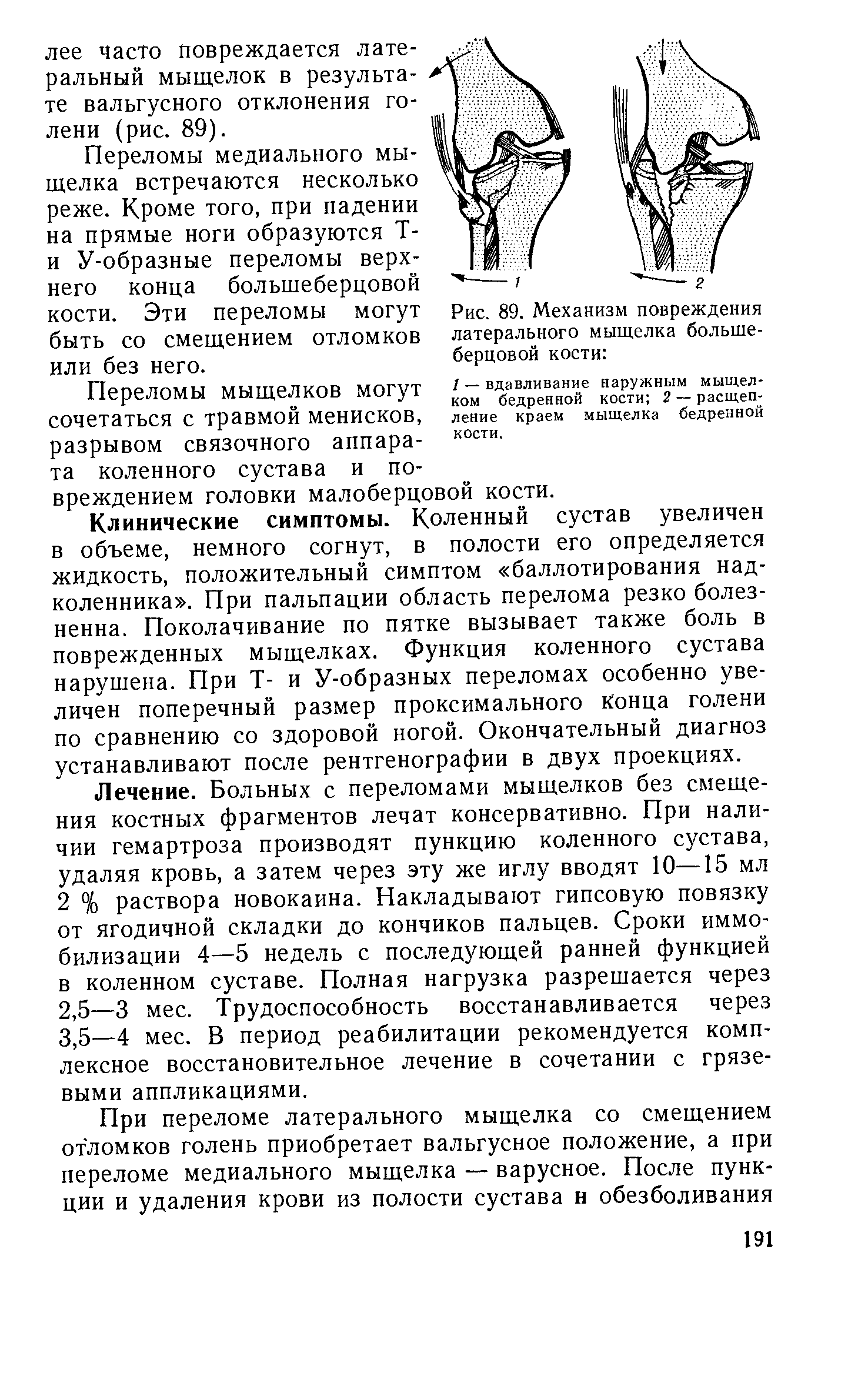 Рис. 89. Механизм повреждения латерального мыщелка большеберцовой кости ...