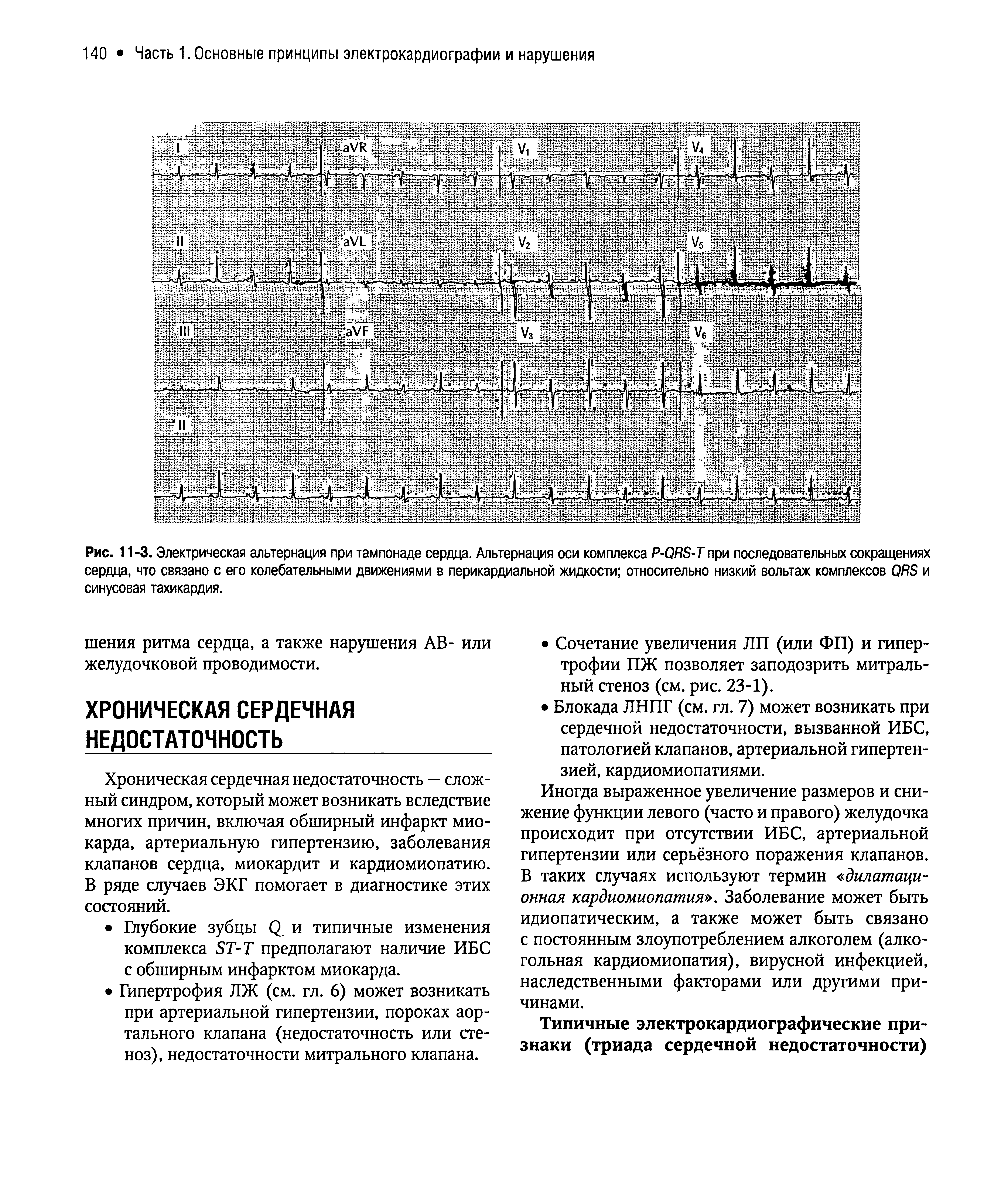 Рис. 11-3. Электрическая альтернация при тампонаде сердца. Альтернация оси комплекса P-QRS-T при последовательных сокращениях сердца, что связано с его колебательными движениями в перикардиальной жидкости относительно низкий вольтаж комплексов QRS и синусовая тахикардия.