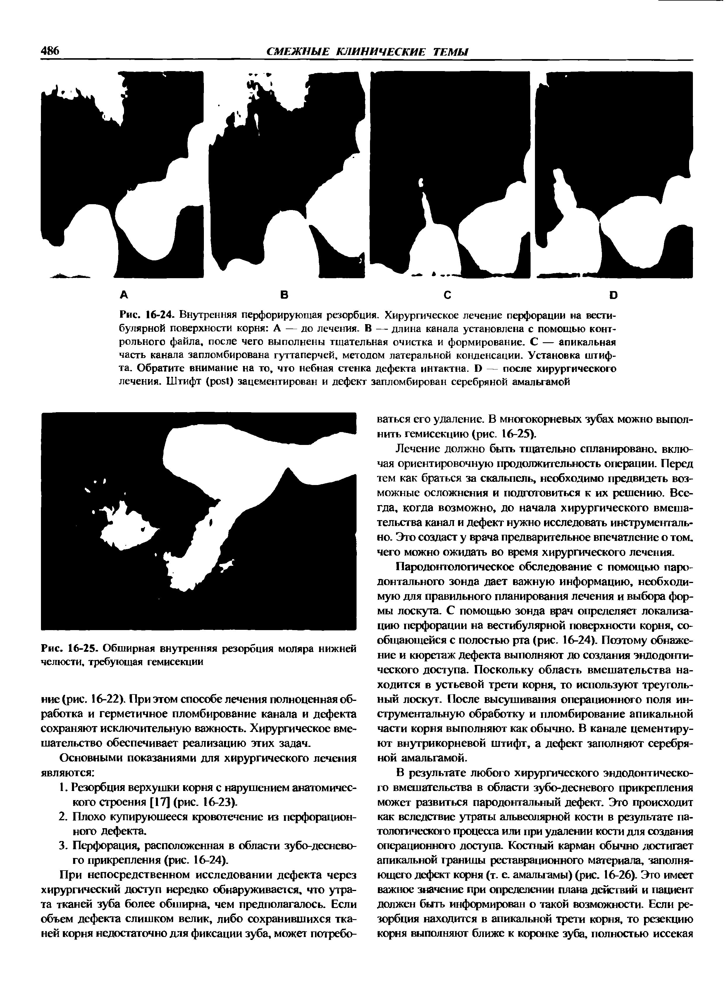 Рис. 16-25. Обширная внутренняя резорбция моляра нижней челюсти, требующая гемисекции...