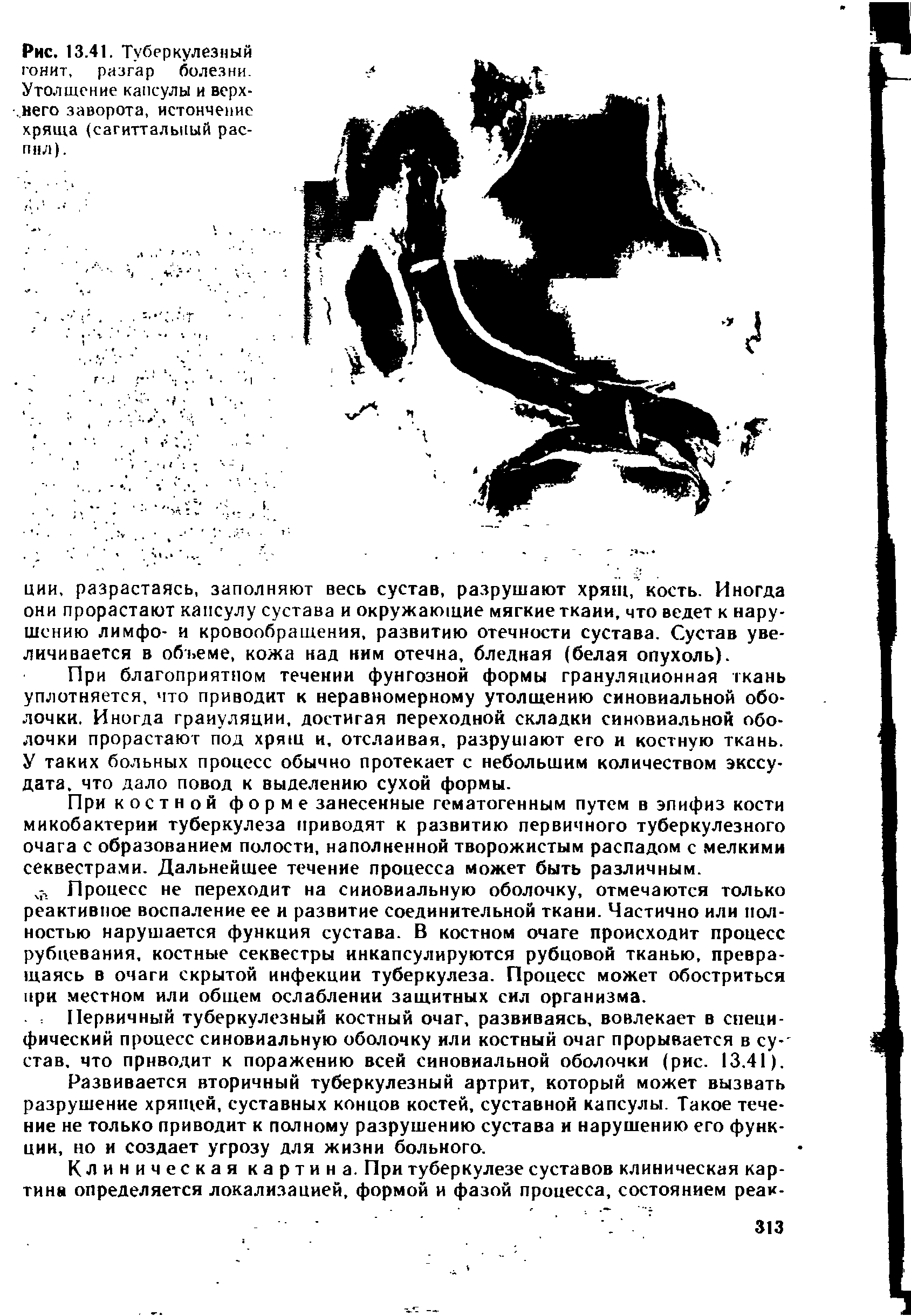 Рис. 13.41. Туберкулезный гонит, разгар болезни. Утолщение капсулы и верхнего заворота, истончение хряща (сагиттальный распил).