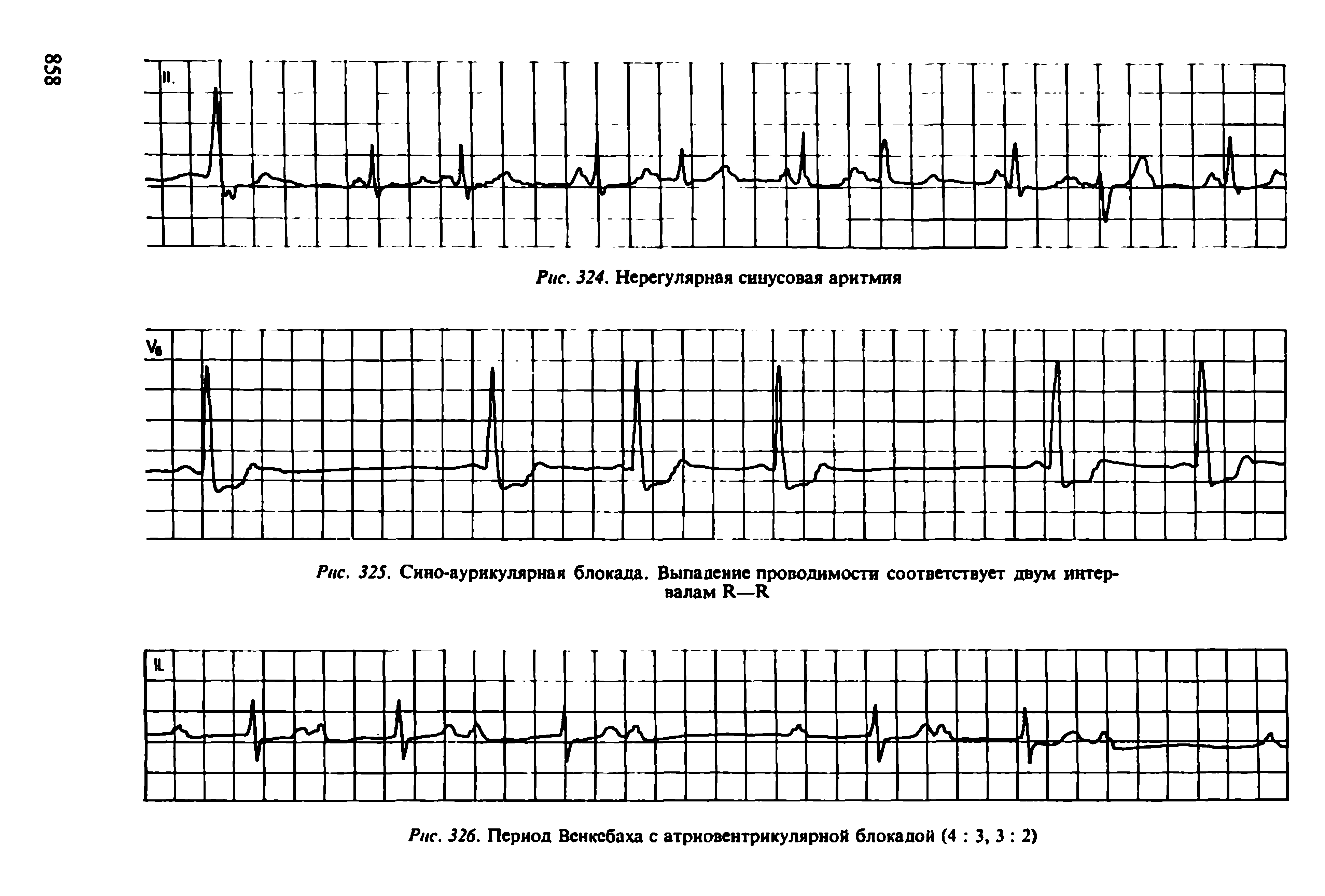 Рис. 325. Сино-аурикулярная блокада. Выпадение проводимости соответствует двум интервалам И—К...