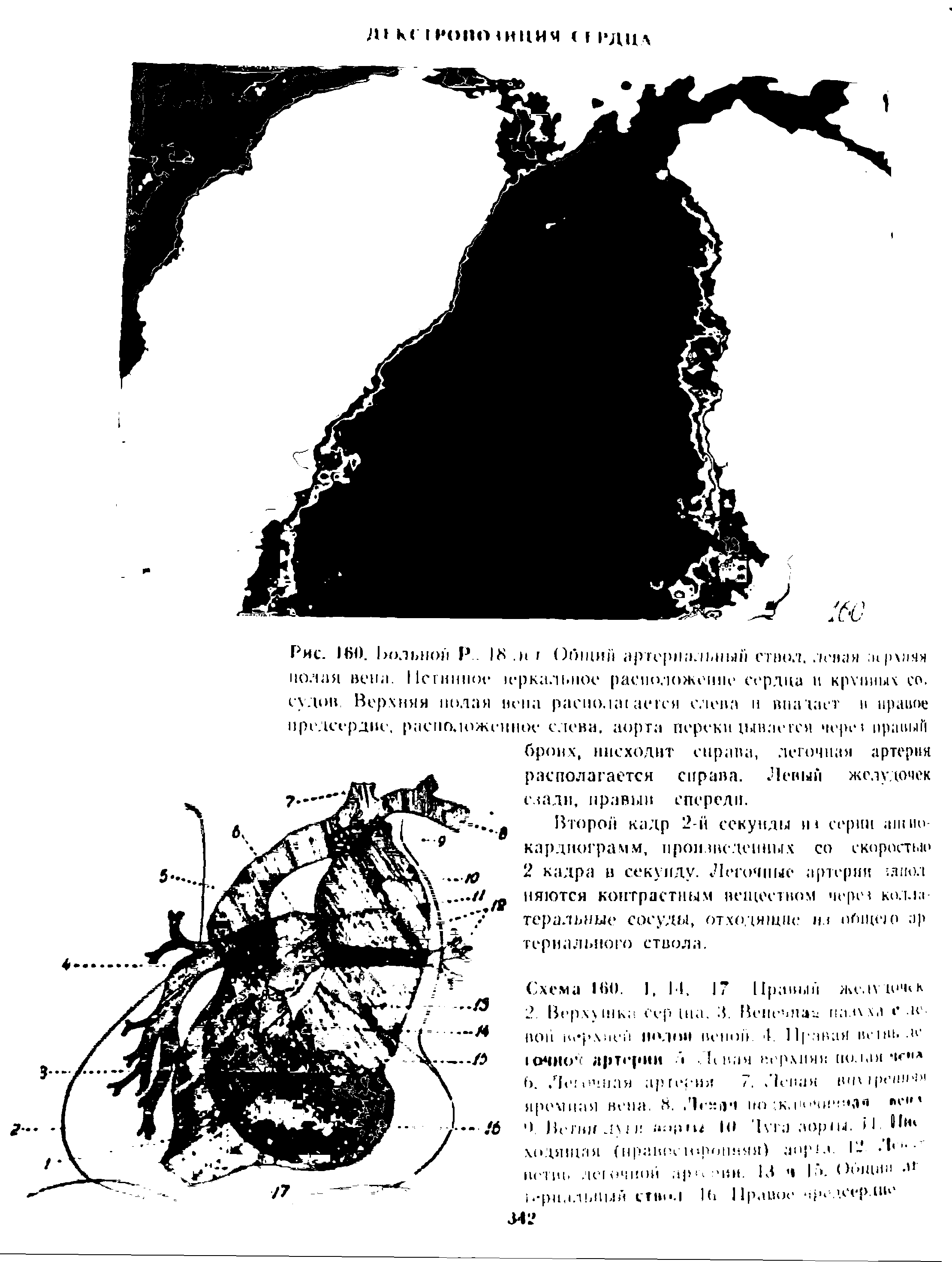 Рис. 160. Вольной Р. 1. н I Общий артериальный ствол,. /сипи. прхпян полая вена. Истинное ц-ркальпое расположение сердца в крупных со. судов Верхняя полая вена раскола асгся слева и впадает и правое предсердие, расположенное слева, аорта перекитыкается черв правый...