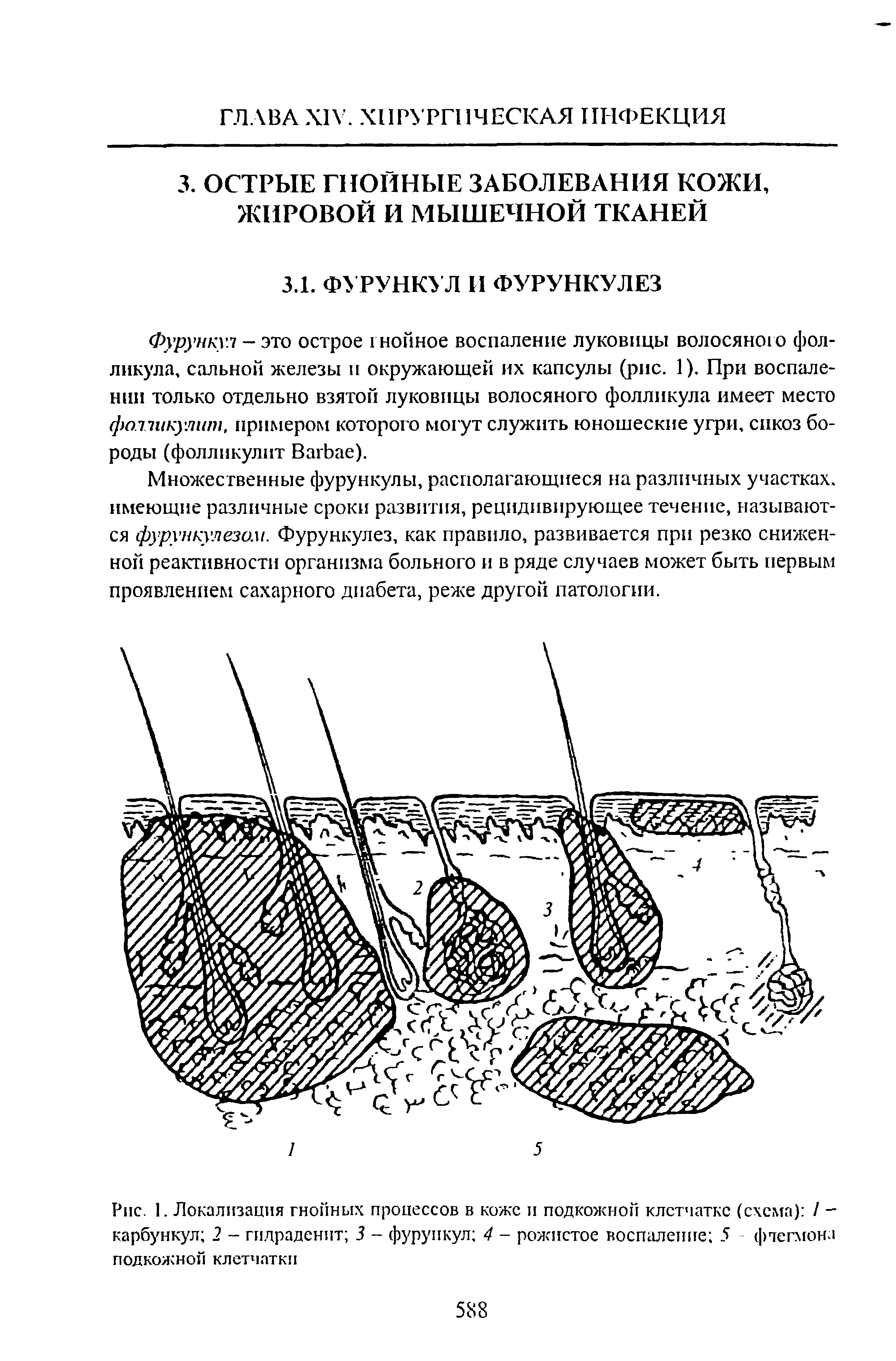 Рис. 1. Локализация гнойных процессов в коже и подкожной клетчатке (схема) / -карбункул 2 - гпдраденпт 3 - фурункул 4 - рожистое воспаление 5 флегмона подкожной клетчатки...