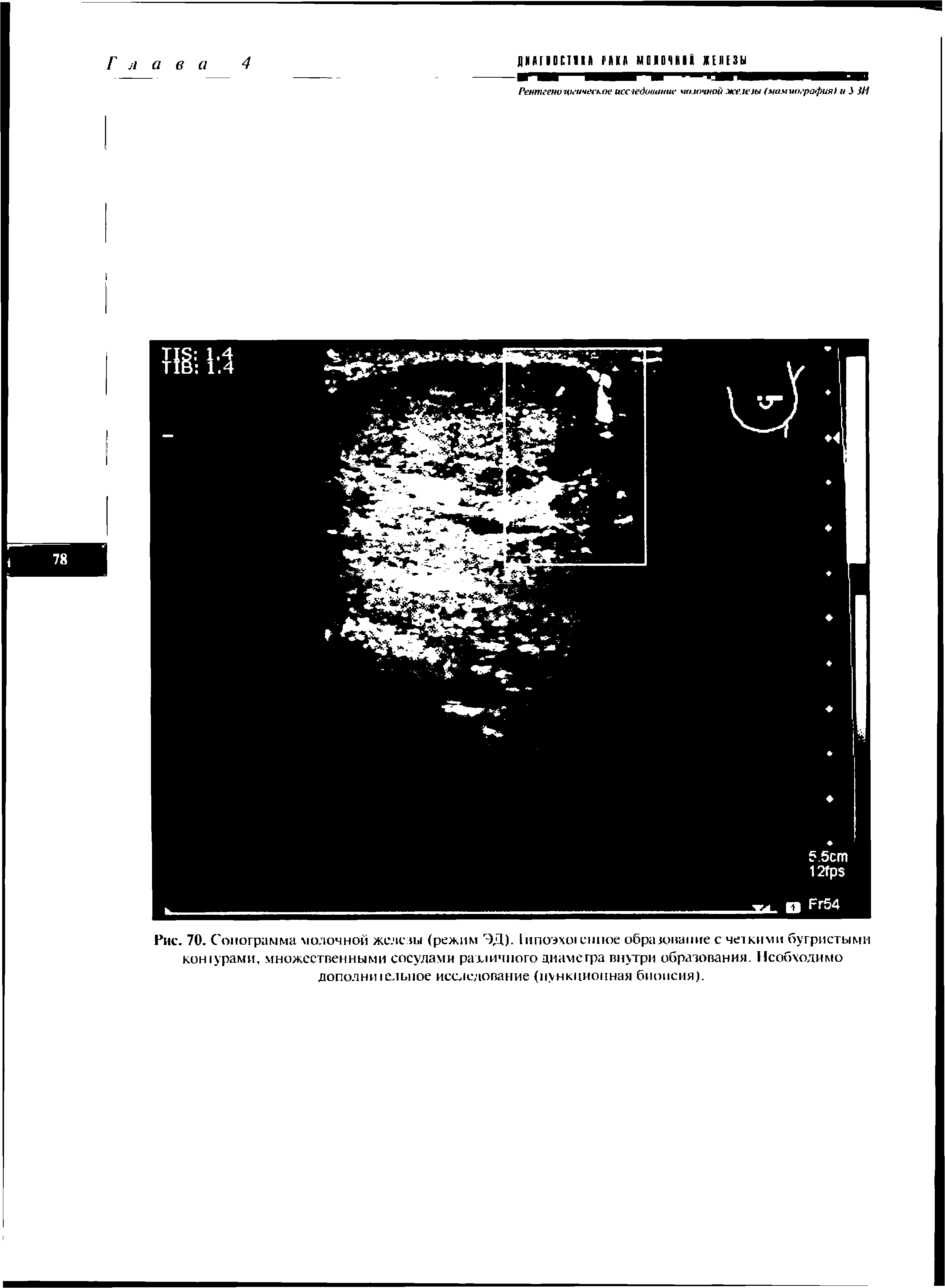 Рис. 70. Сонограмма молочной железы (режим ЭД). 1ипоэхо1 енпое образование с четкими бугристыми кошурами, множественными сосудами различного диаметра внутри образования. Необходимо дополни I сльиое исследование (пункционная биопсия).