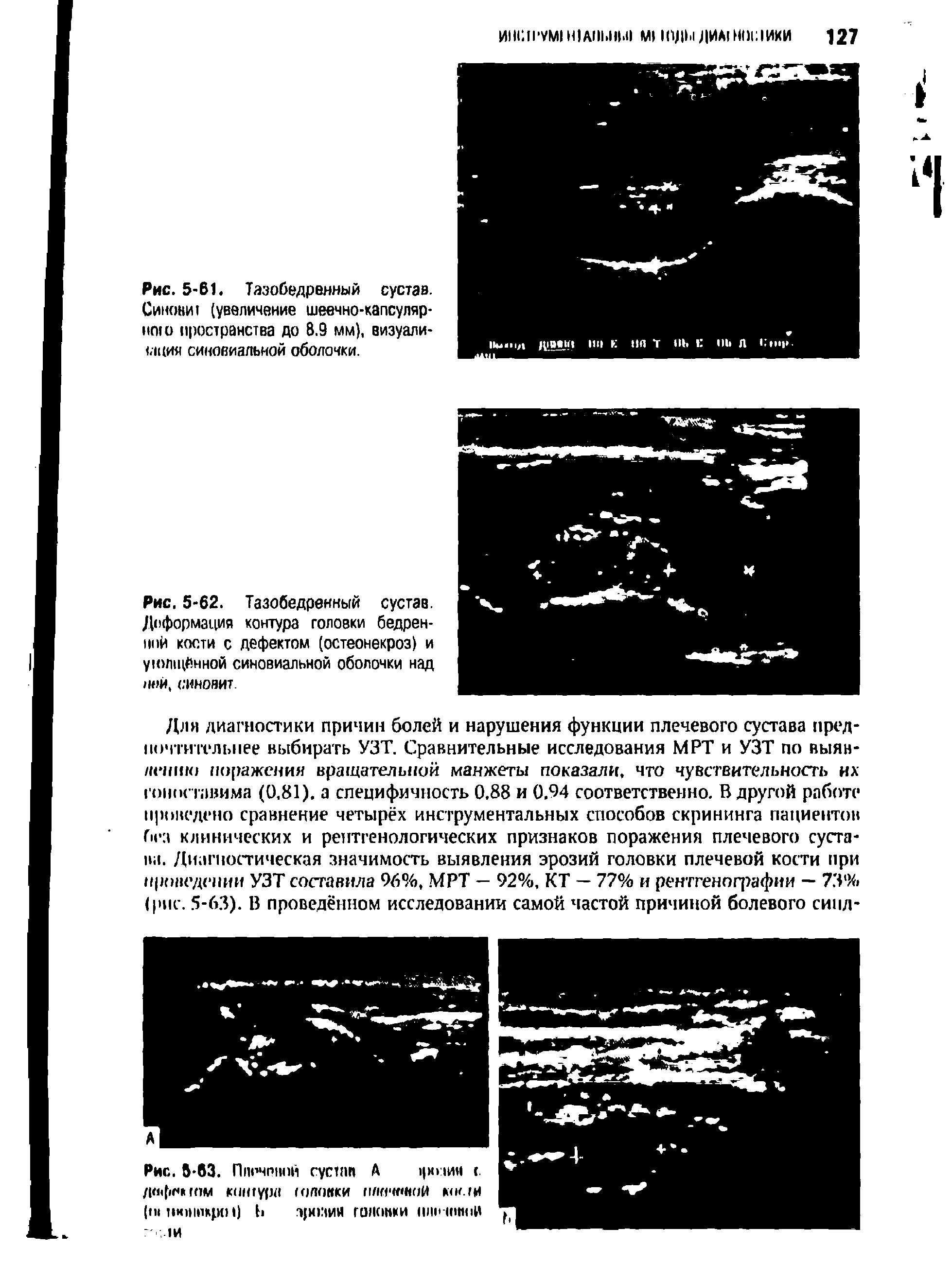 Рис. 5-62. Тазобедренный сустав. Деформация контура головки бедренной кости с дефектом (остеонекроз) и ук>Л1Ц0нной синовиальной оболочки над 1И)Й, синовит.