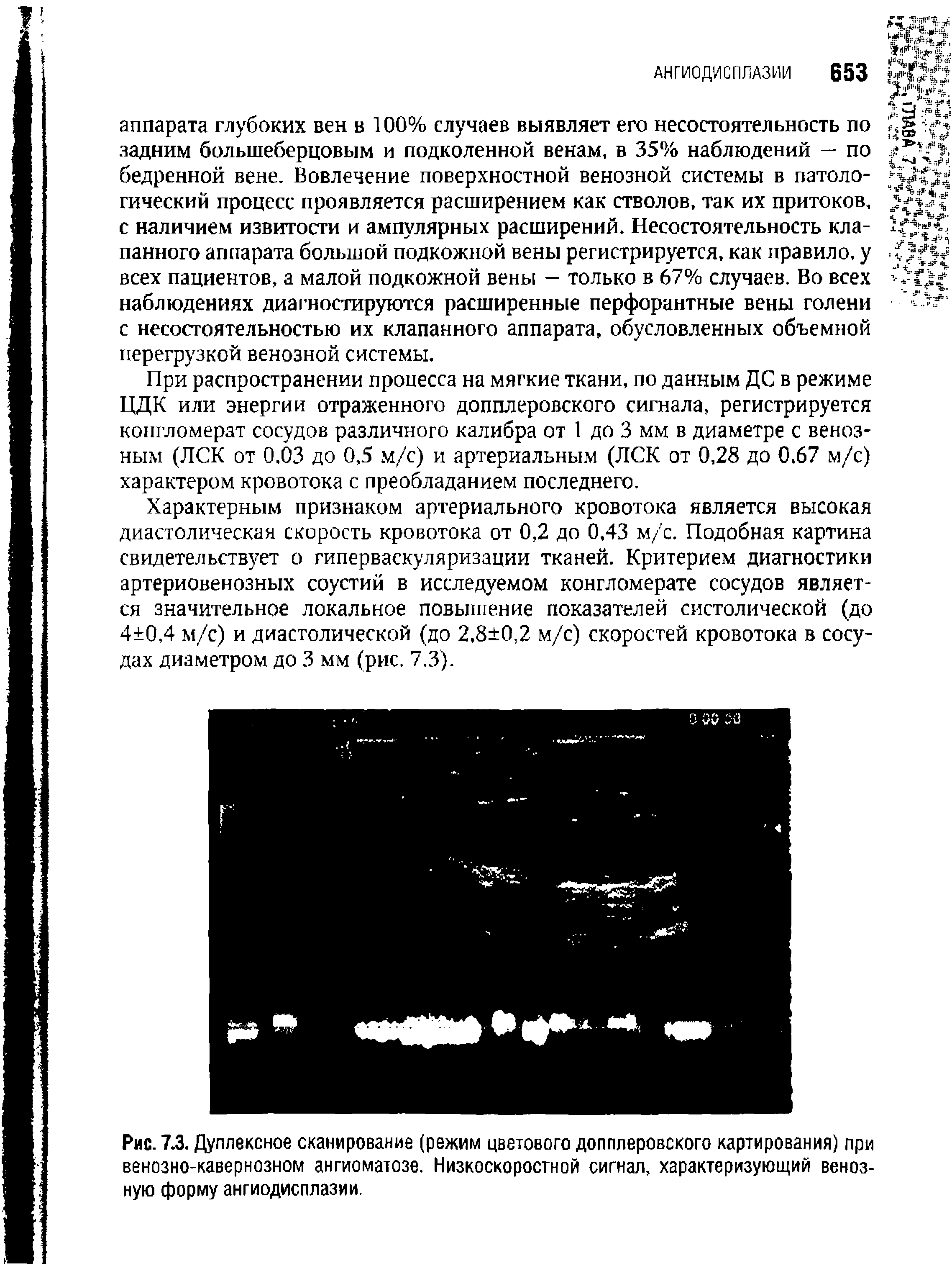 Рис. 7.3. Дуплексное сканирование (режим цветового допплеровского картирования) при венозно-кавернозном ангиоматозе. Низкоскоростной сигнал, характеризующий венозную форму ангиодисплазии.