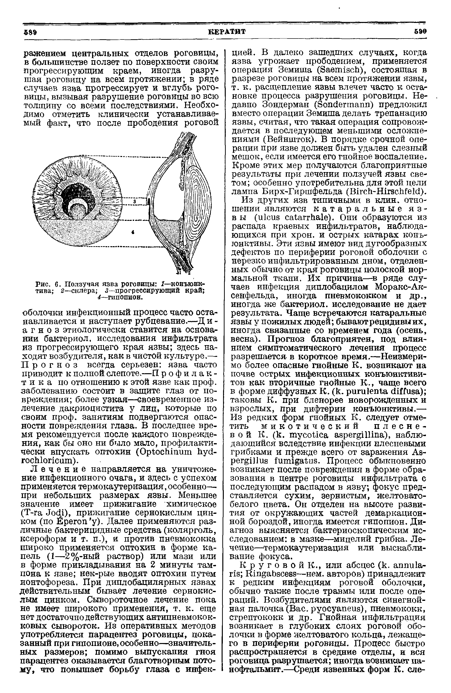 Рис. 6. Ползучая язва роговицы Г—конъюнктива 2—склера 3—прогрессирующий край 4 гипопион.