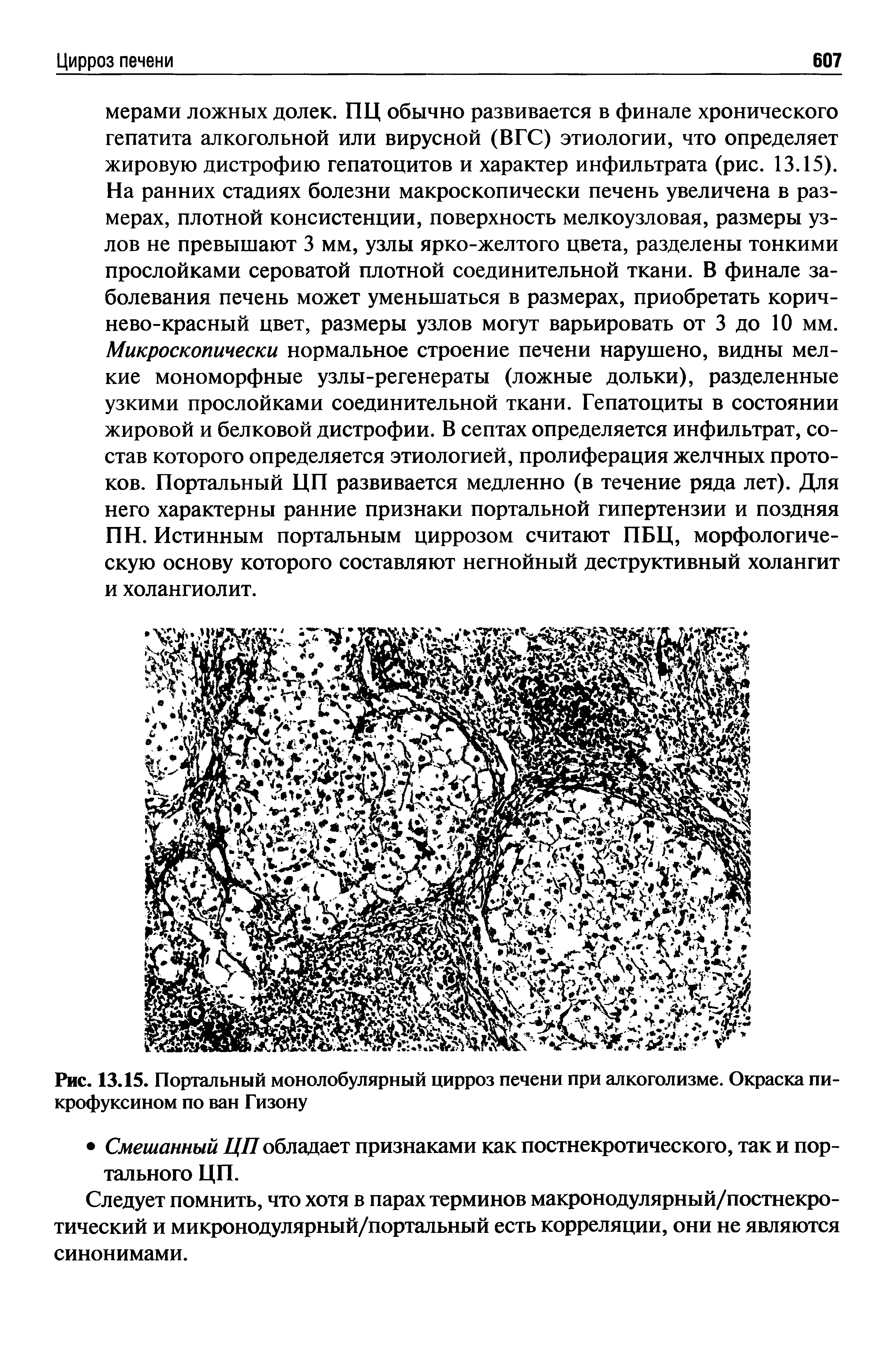 Рис. 13.15. Портальный монолобулярный цирроз печени при алкоголизме. Окраска пи-крофуксином по ван Гизону...