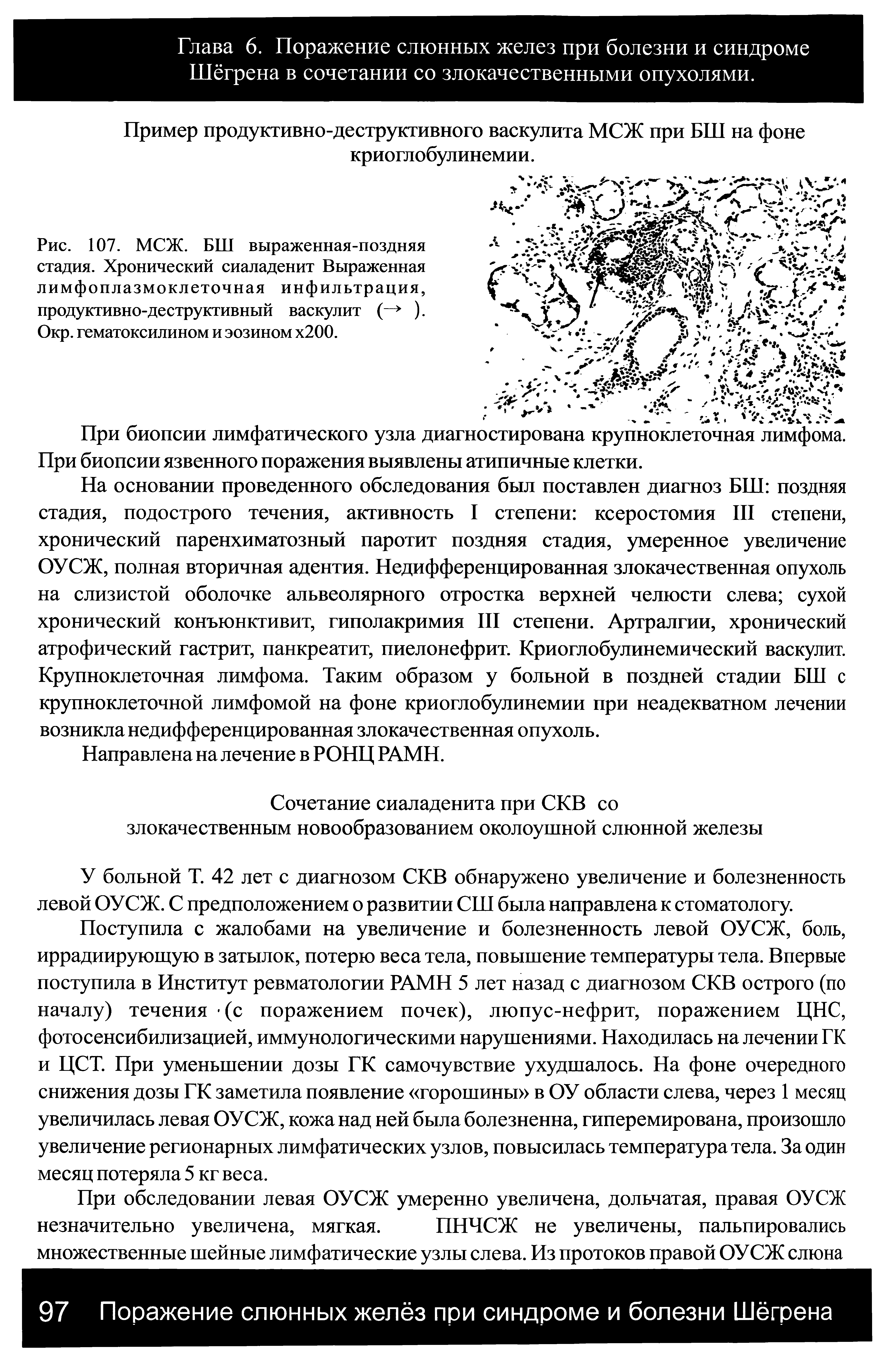 Рис. 107. МСЖ. БШ выраженная-поздняя стадия. Хронический сиаладенит Выраженная лимфоплазмоклеточная инфильтрация, продуктивно-деструктивный васкулит (—> ). Окр. гематоксилином и эозином х200.