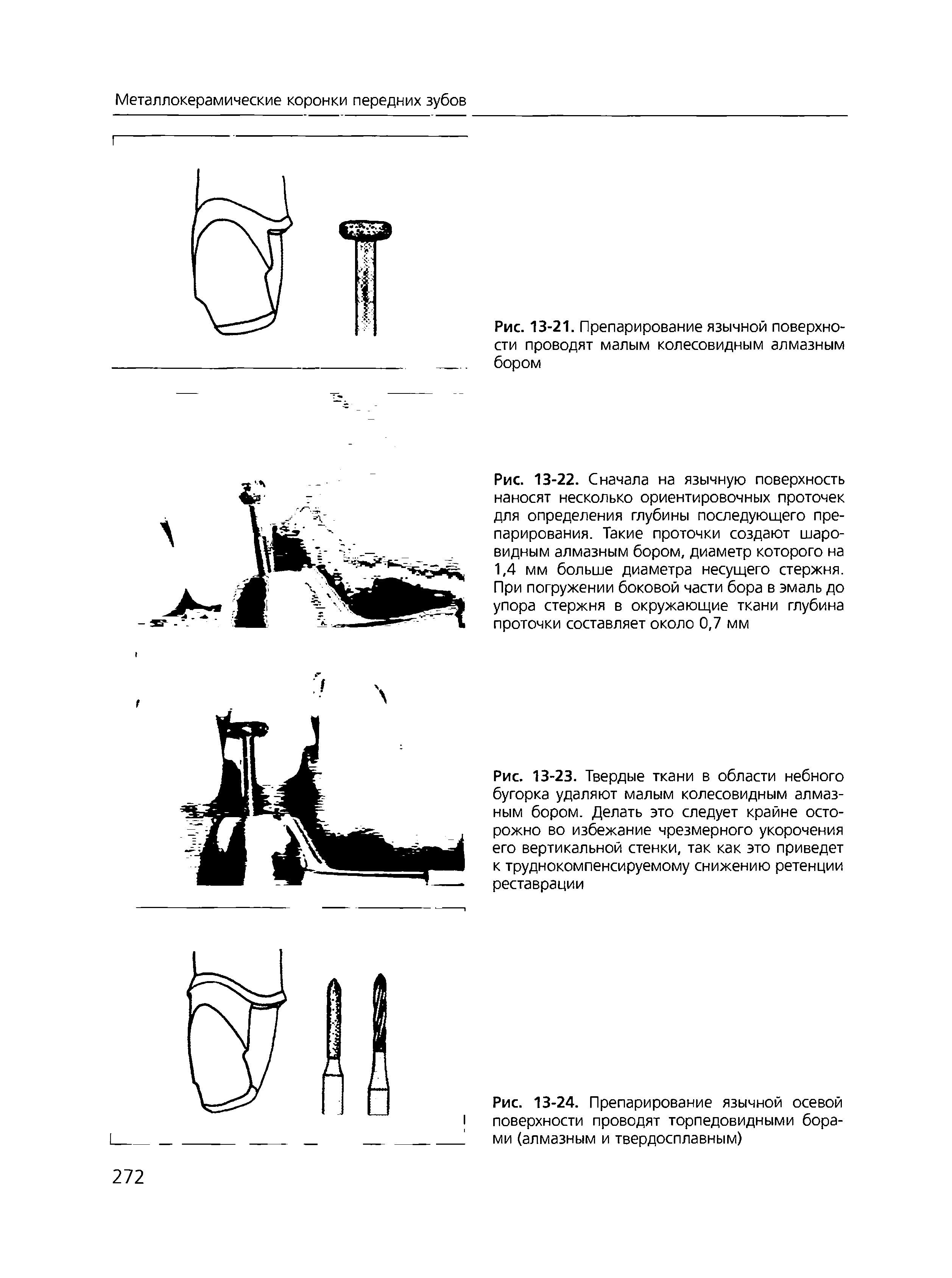 Рис. 13-24. Препарирование язычной осевой поверхности проводят торпедовидными борами (алмазным и твердосплавным)...