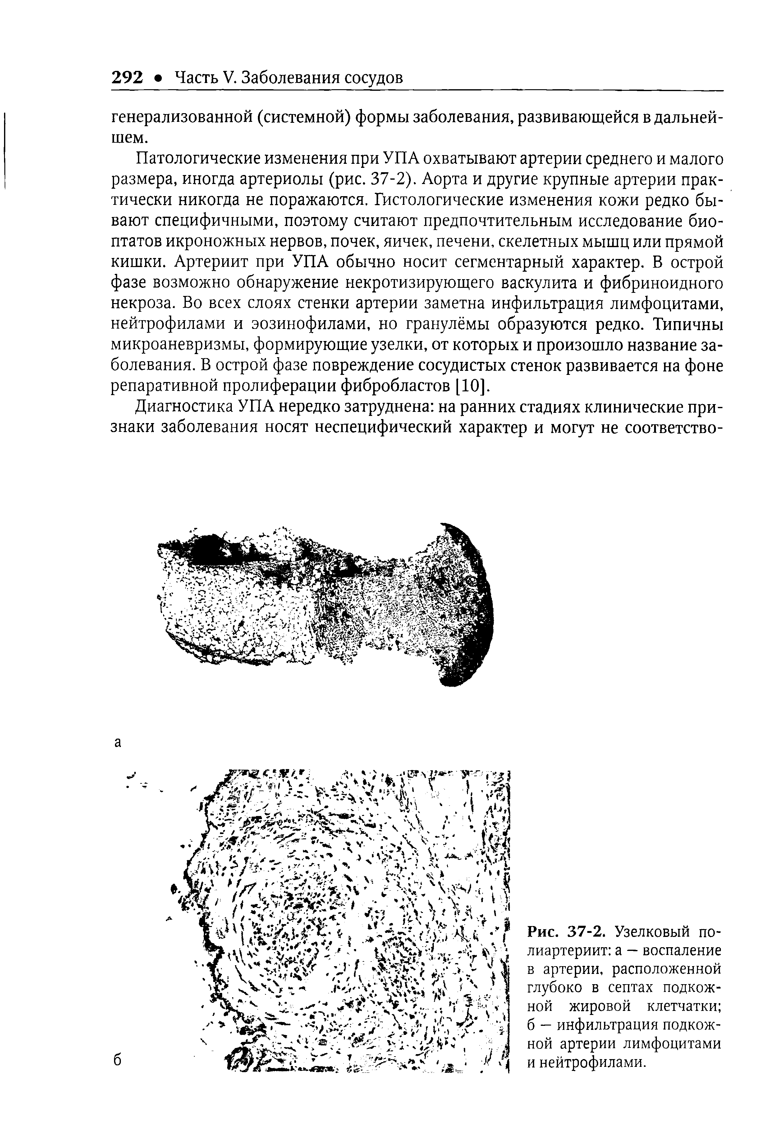 Рис. 37-2. Узелковый полиартериит а — воспаление в артерии, расположенной глубоко в септах подкожной жировой клетчатки б — инфильтрация подкожной артерии лимфоцитами и нейтрофилами.