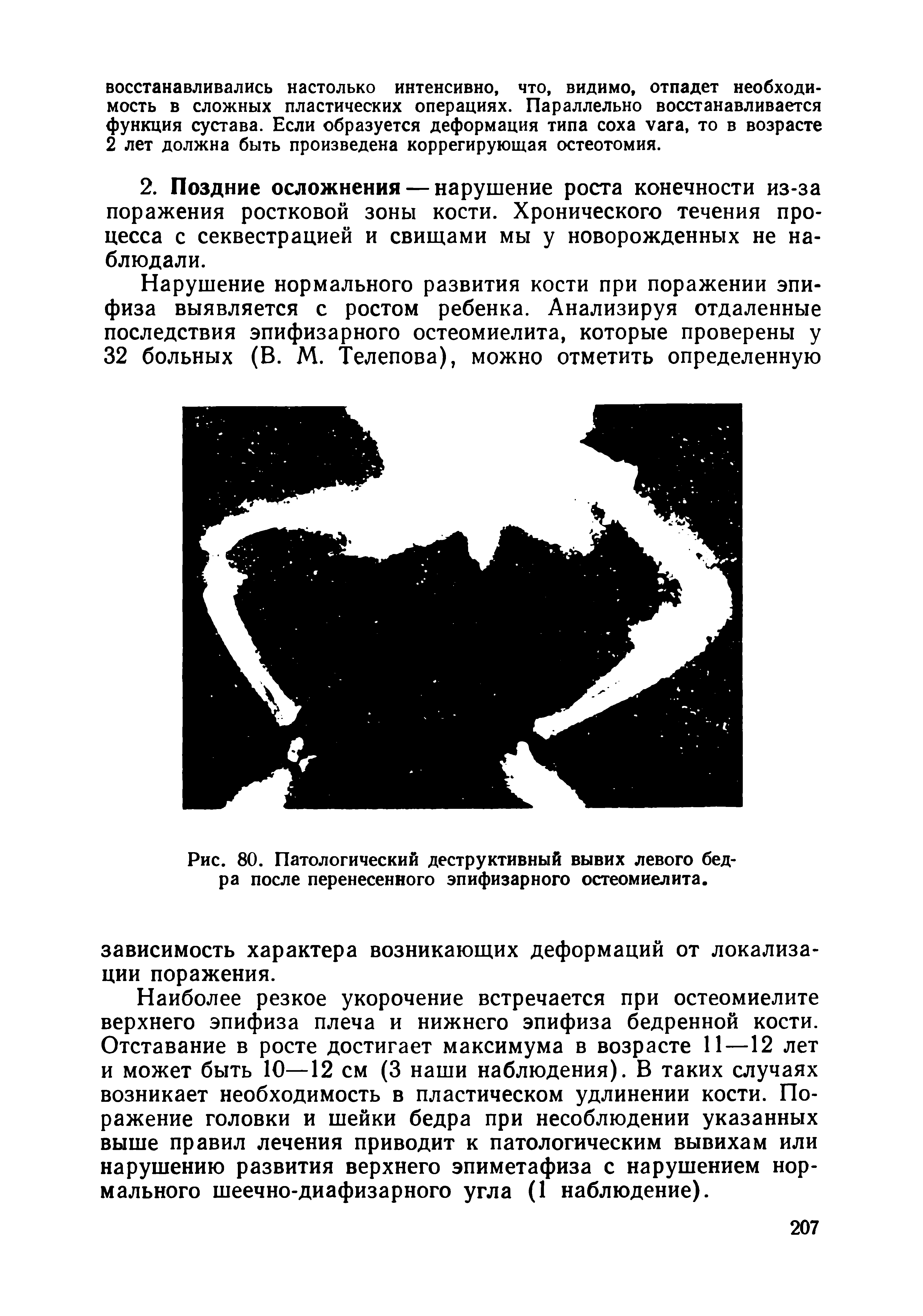 Рис. 80. Патологический деструктивный вывих левого бедра после перенесенного эпифизарного остеомиелита.