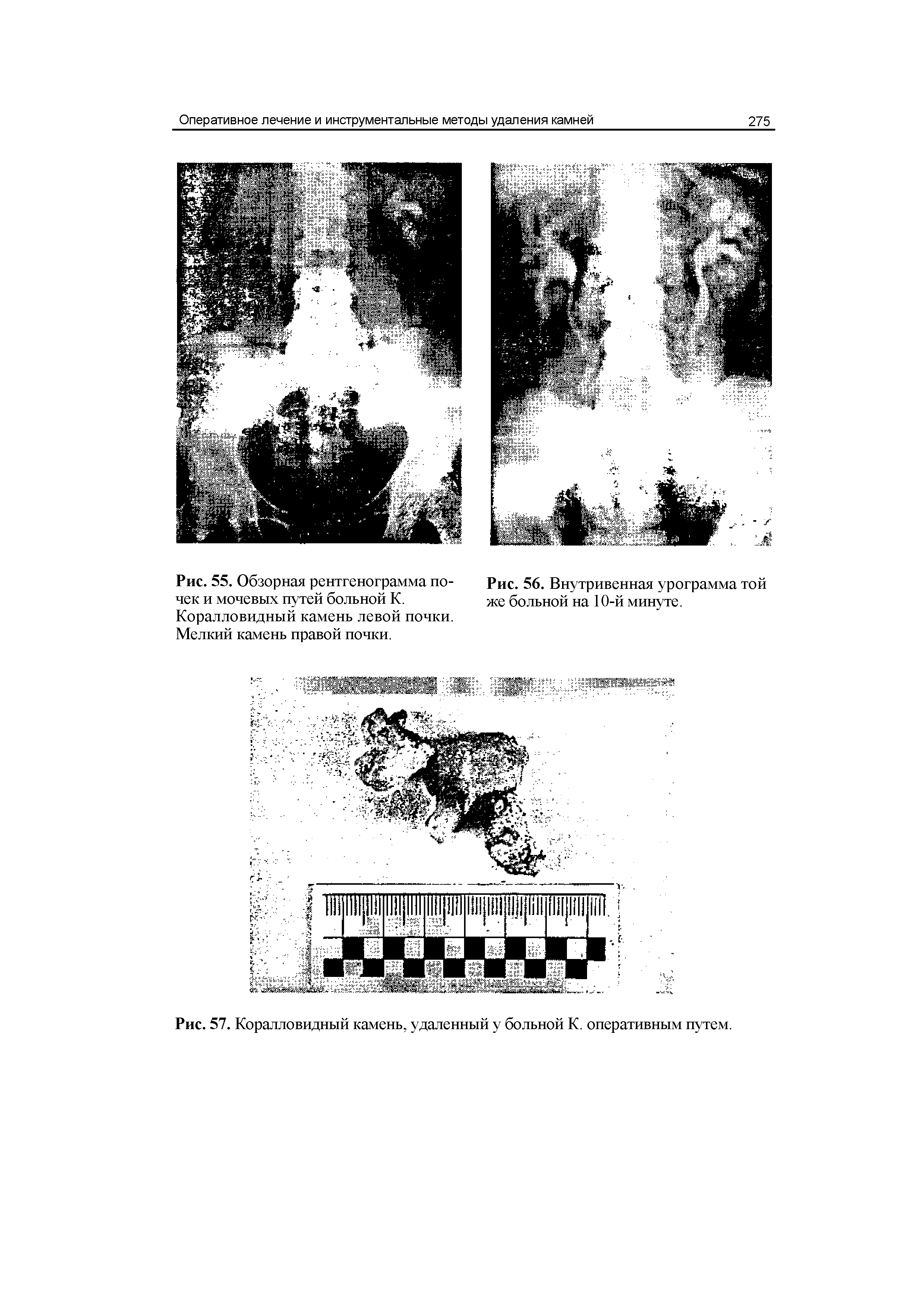 Рис. 57. Коралловидный камень, удаленный у больной К. оперативным путем.