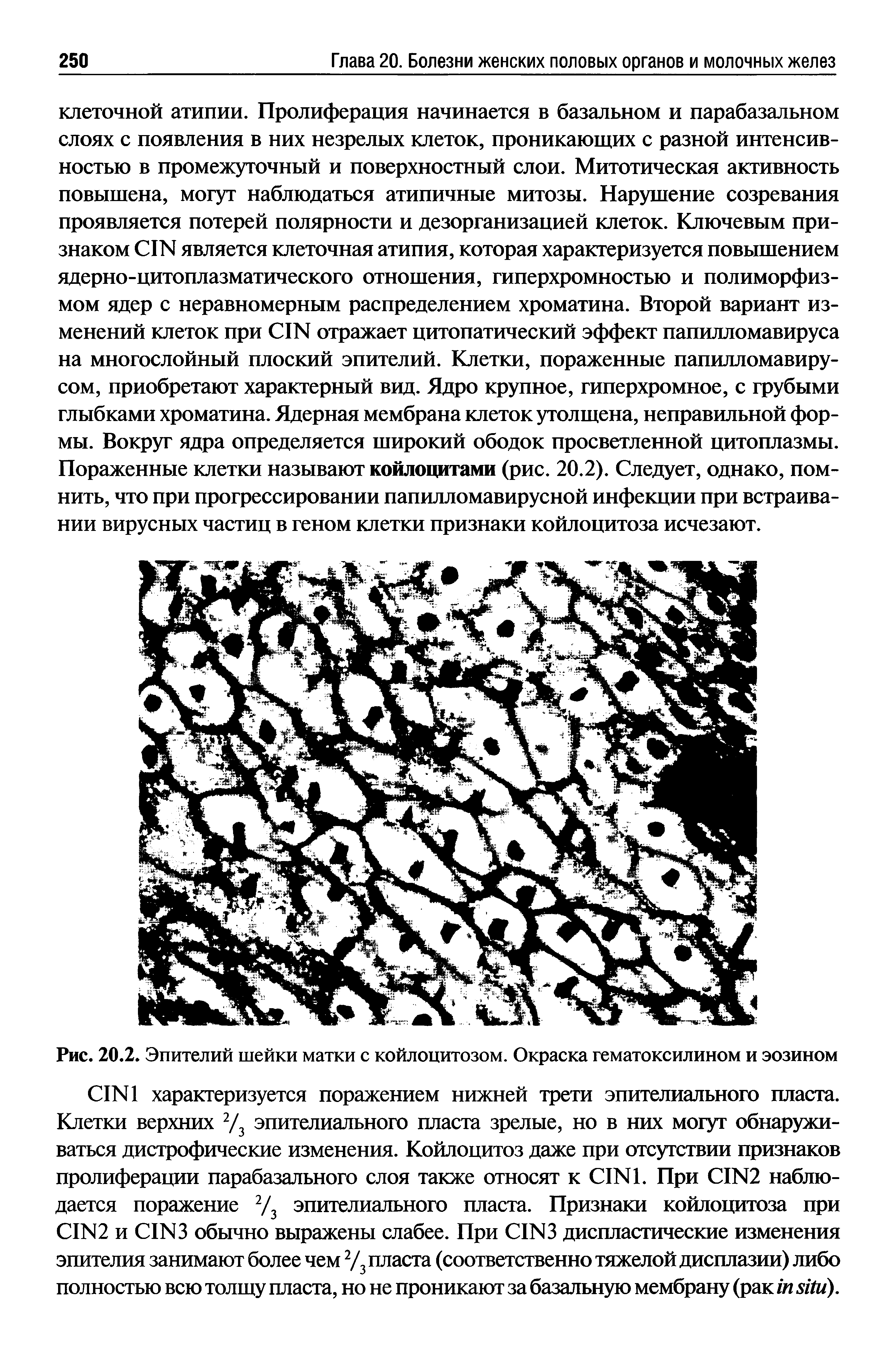 Рис. 20.2. Эпителий шейки матки с койлоцитозом. Окраска гематоксилином и эозином...
