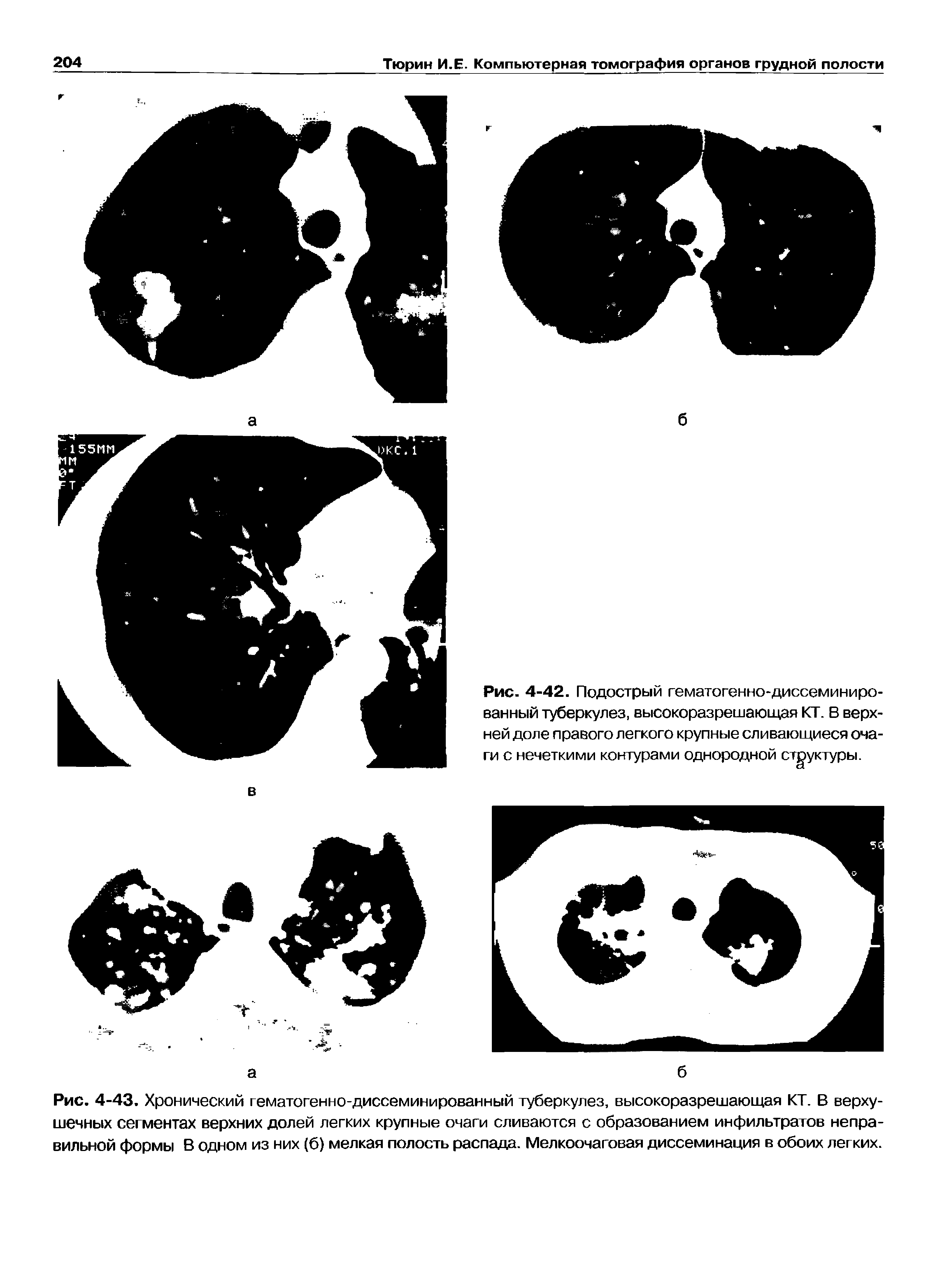 Рис. 4-42. Подострый гематогенно-диссеминиро-ванный туберкулез, высокоразрешающая КТ. В верхней доле правого легкого крупные сливающиеся очаги с нечеткими контурами однородной структуры.