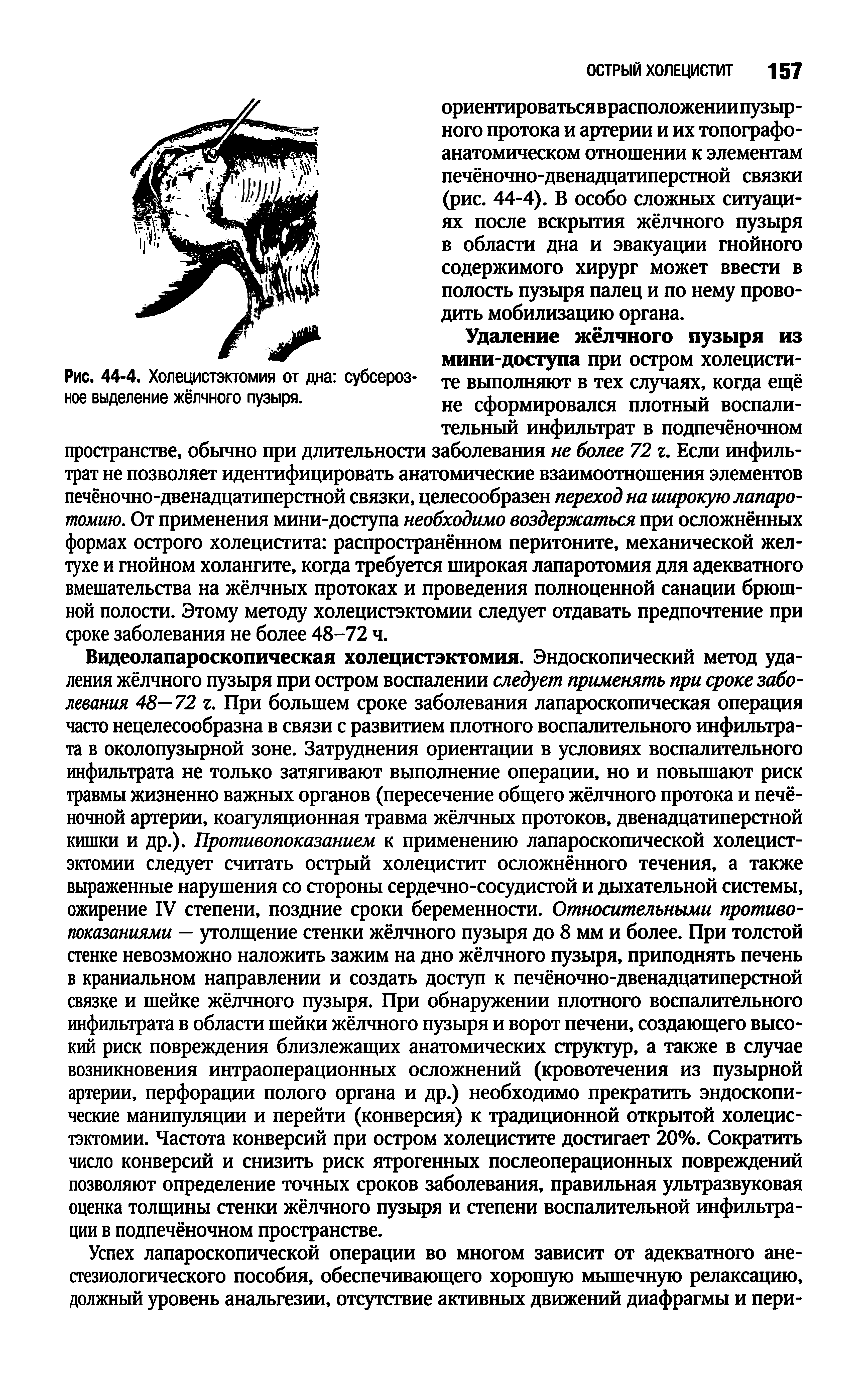 Рис. 44-4. Холецистэктомия от дна субсероз- те выполняют в тех случаях, когда ещё ное выделение жёлчного пузыря. не сформировался плотный воспали-...