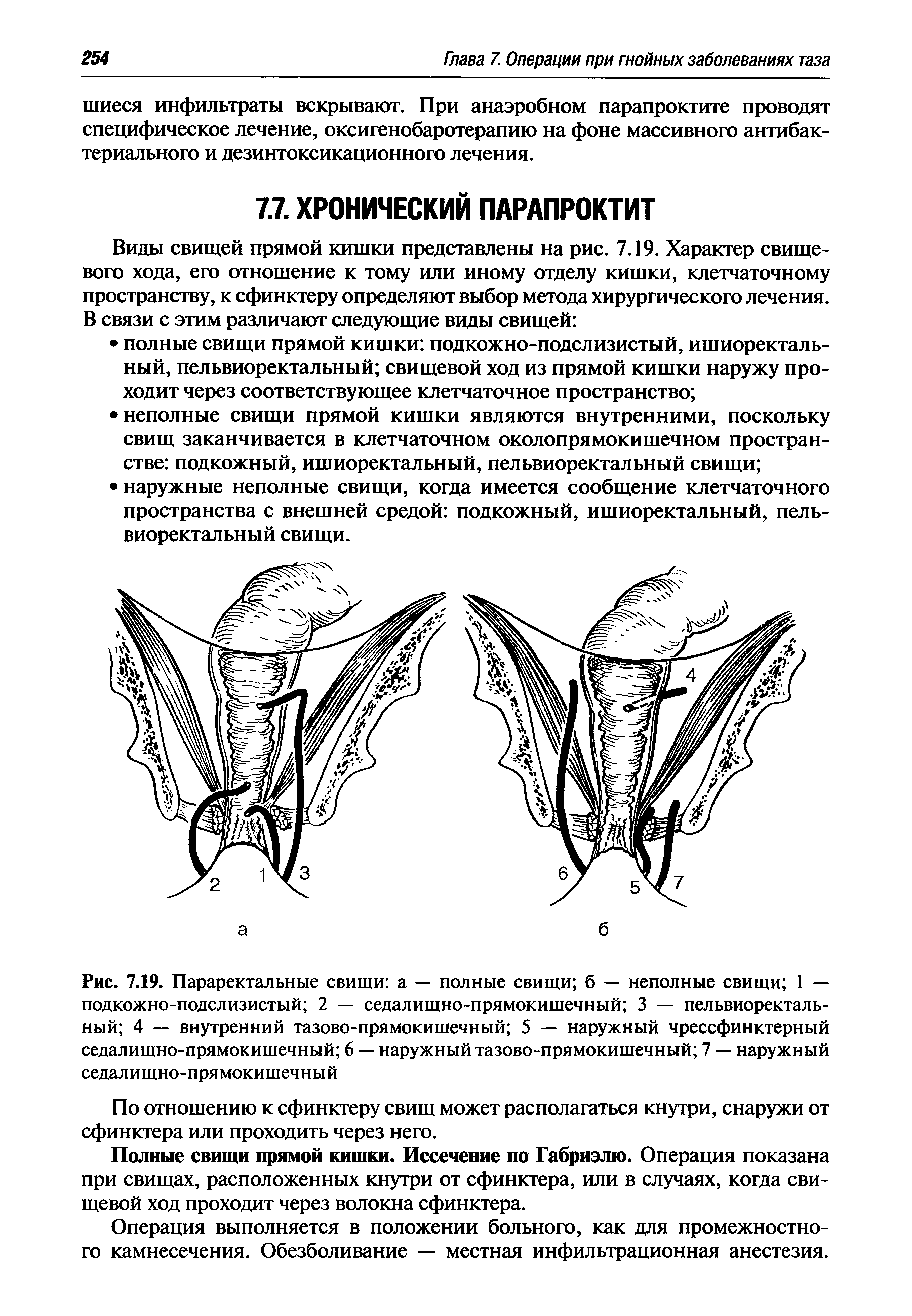 Рис. 7.19. Параректальные свищи а — полные свищи б — неполные свищи 1 — подкожно-подслизистый 2 — седалищно-прямокишечный 3 — пельвиоректальный 4 — внутренний тазово-прямокишечный 5 — наружный чрессфинктерный седалищно-прямокишечный 6 — наружный тазово-прямокишечный 7 — наружный седалищно-прямокишечный...