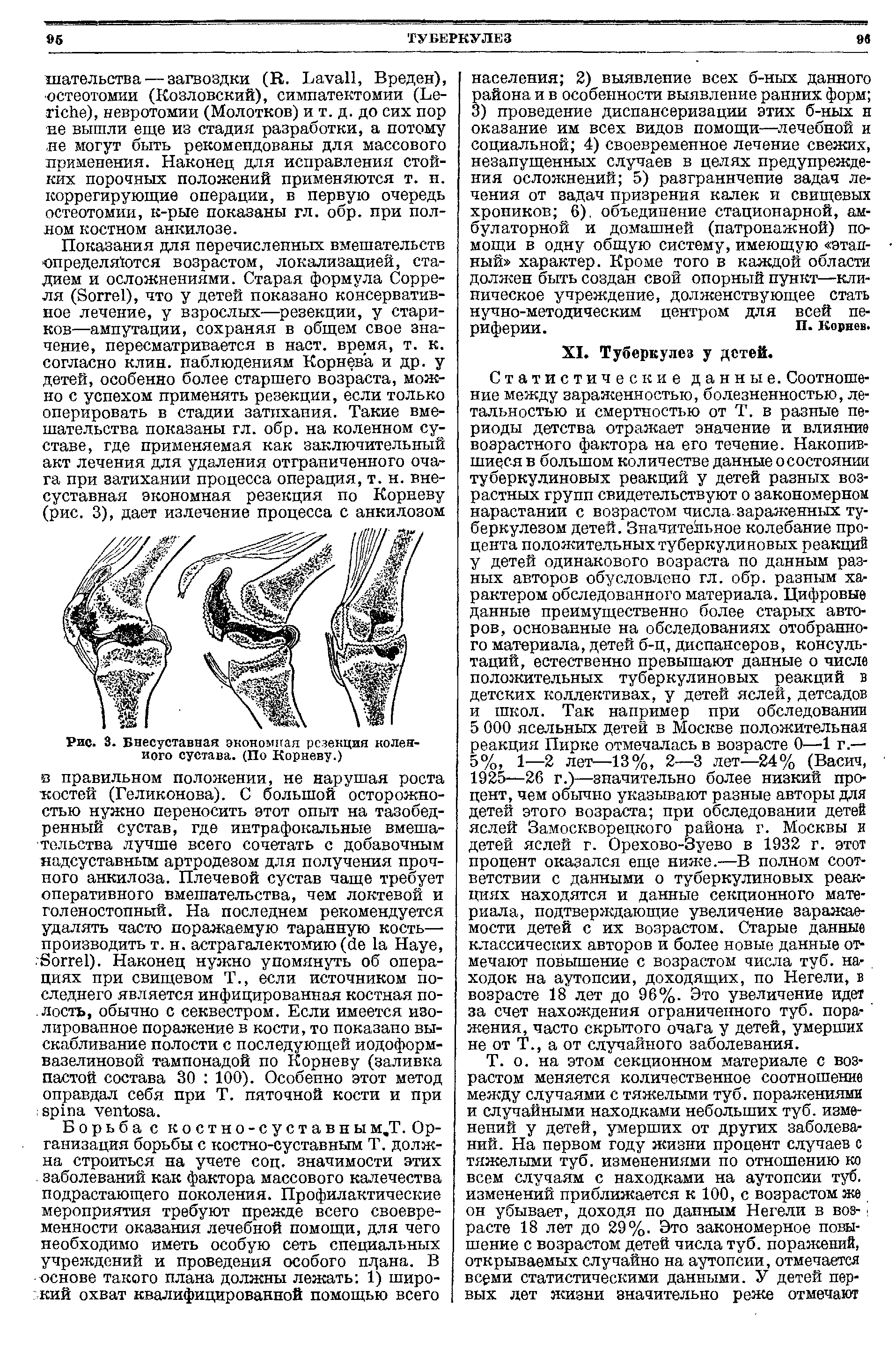 Рис. 3. Бнесуставная экономная резекция коленного сустава. (По Корневу.)...