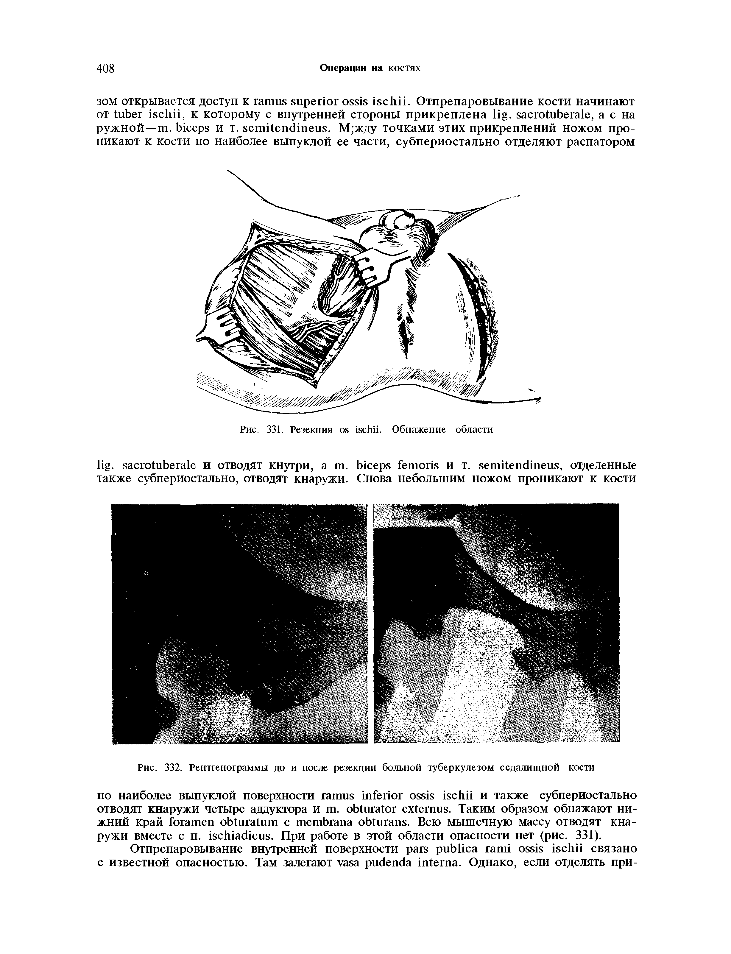 Рис. 332. Рентгенограммы до и после резекции больной туберкулезом седалищной кости...