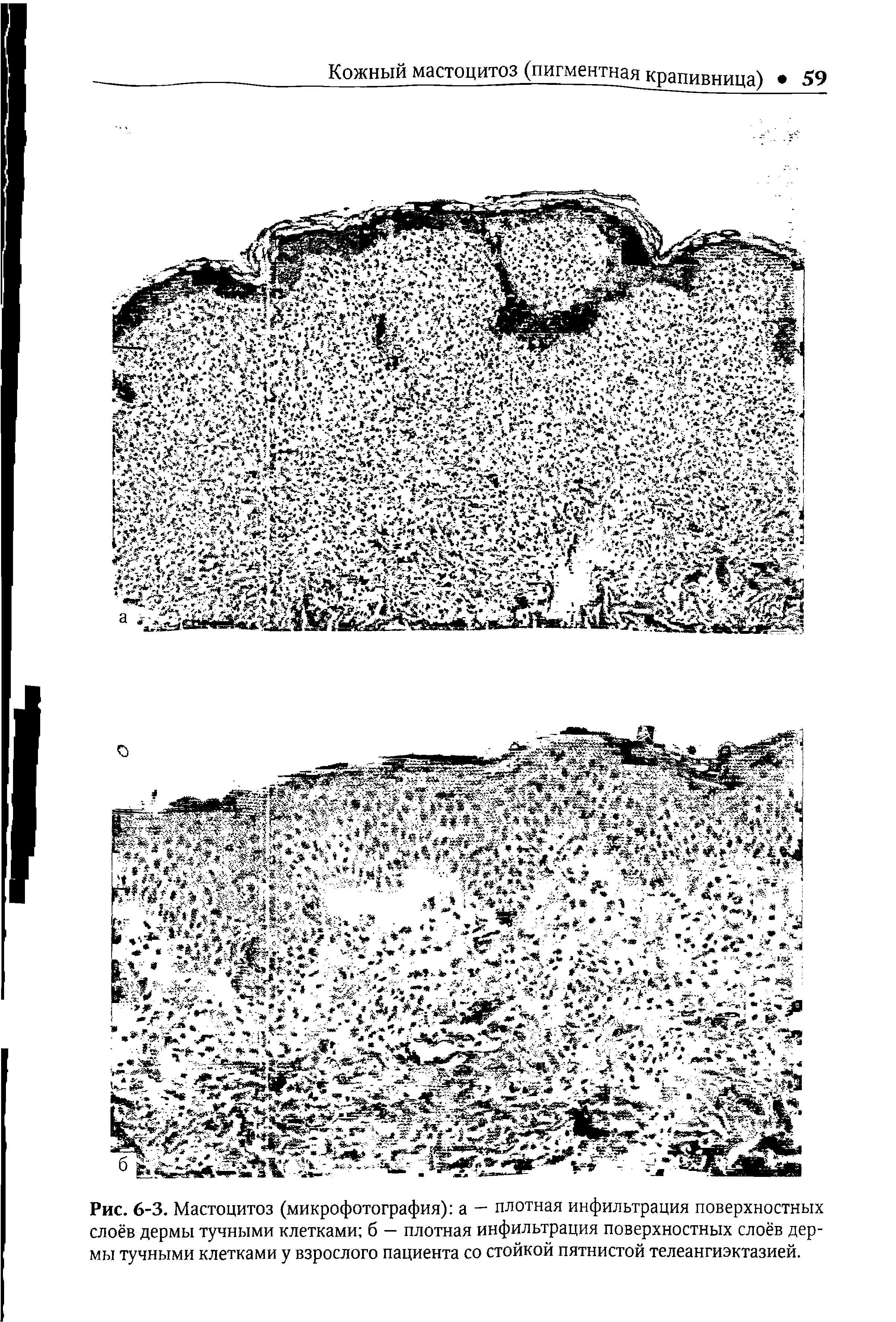 Рис. 6-3. Мастоцитоз (микрофотография) а — плотная инфильтрация поверхностных слоёв дермы тучными клетками б — плотная инфильтрация поверхностных слоёв дермы тучными клетками у взрослого пациента со стойкой пятнистой телеангиэктазией.