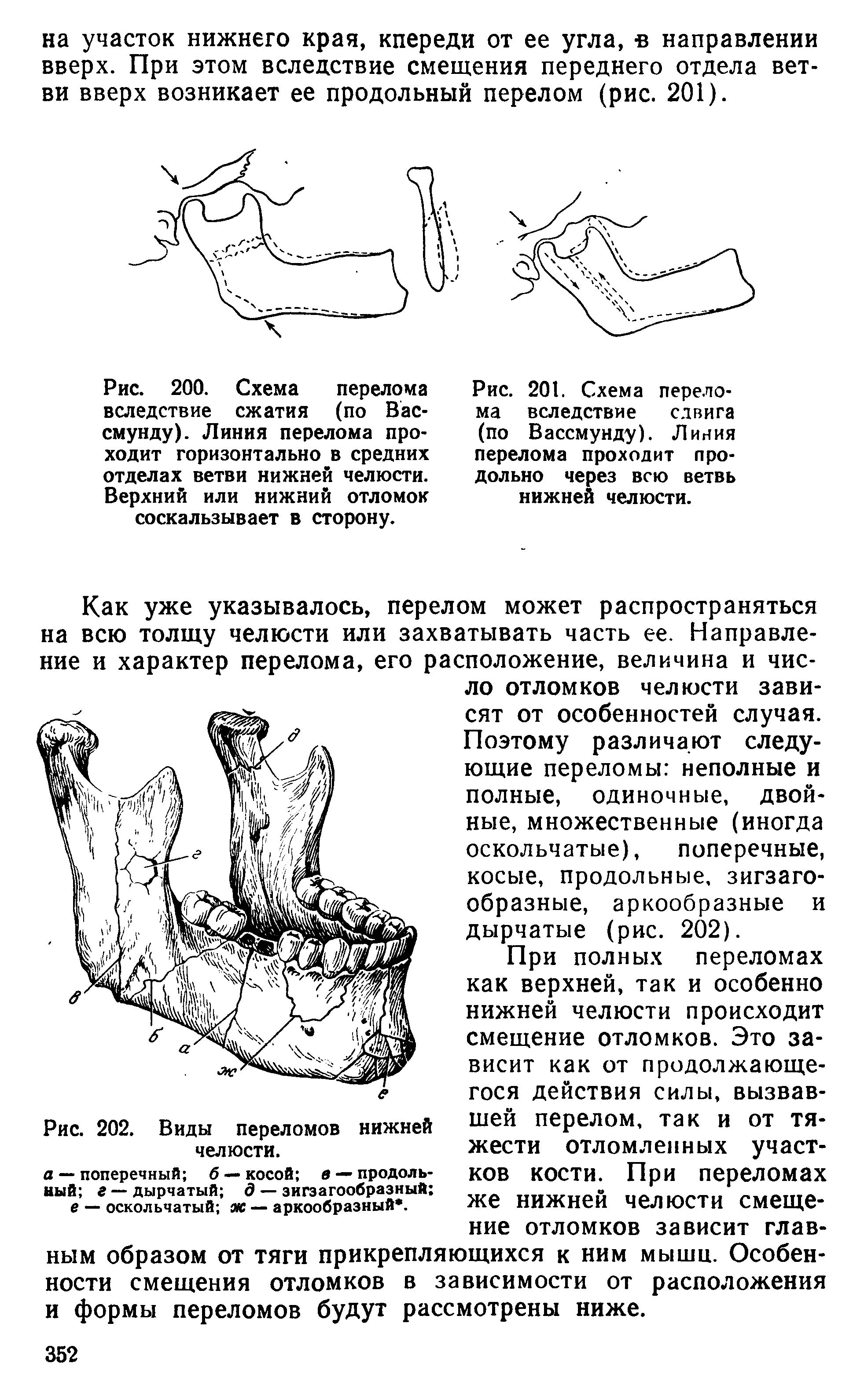 Рис. 200. Схема перелома вследствие сжатия (по Вас-смунду). Линия перелома проходит горизонтально в средних отделах ветви нижней челюсти. Верхний или нижний отломок соскальзывает в сторону.