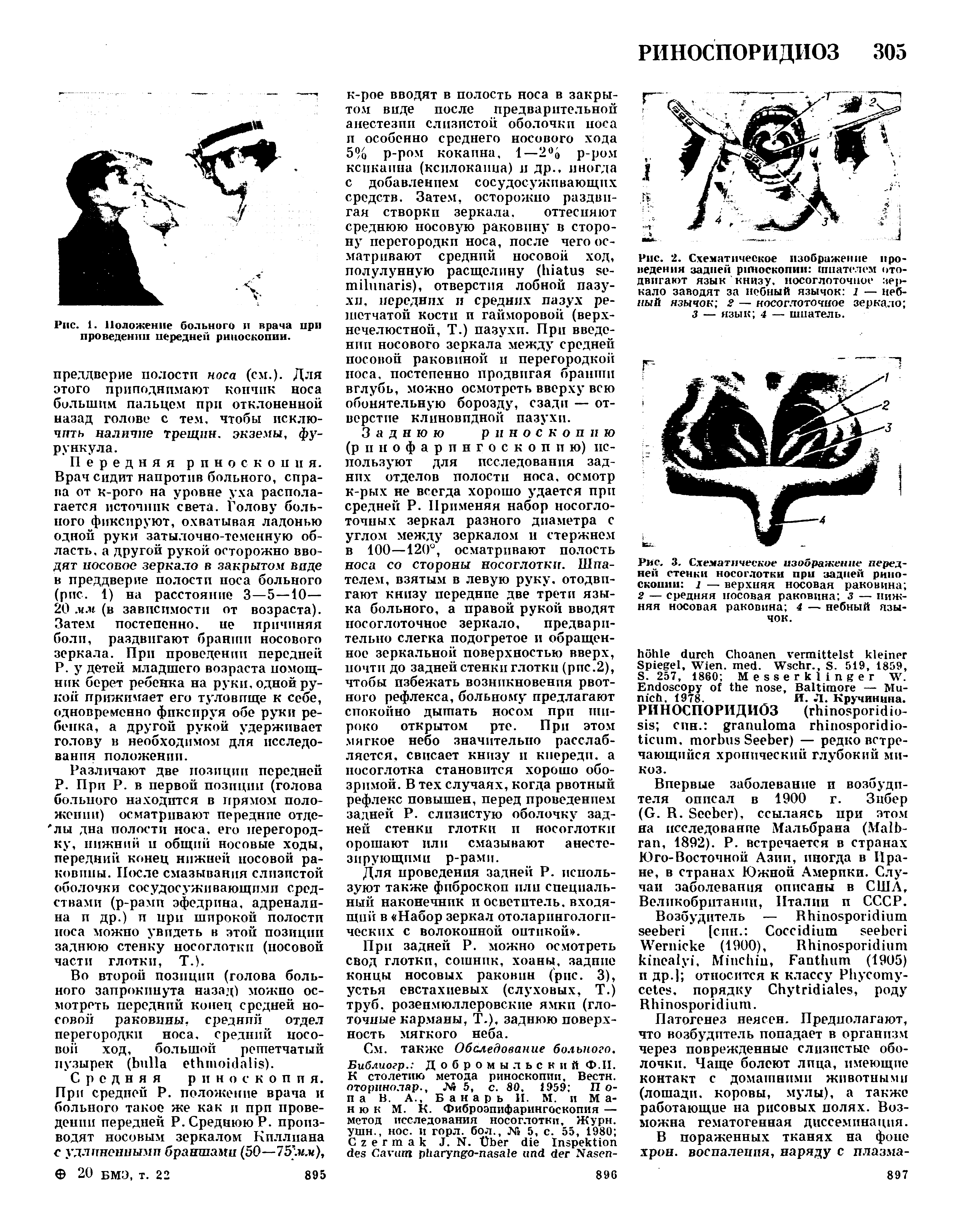 Рис. 2. Схематическое изображение проведения задней риноскопии шпателем отодвигают язык книзу, носоглоточное зе >-кало заводят за небный язычок I — небный язычок 2 — носоглоточное зеркало ...