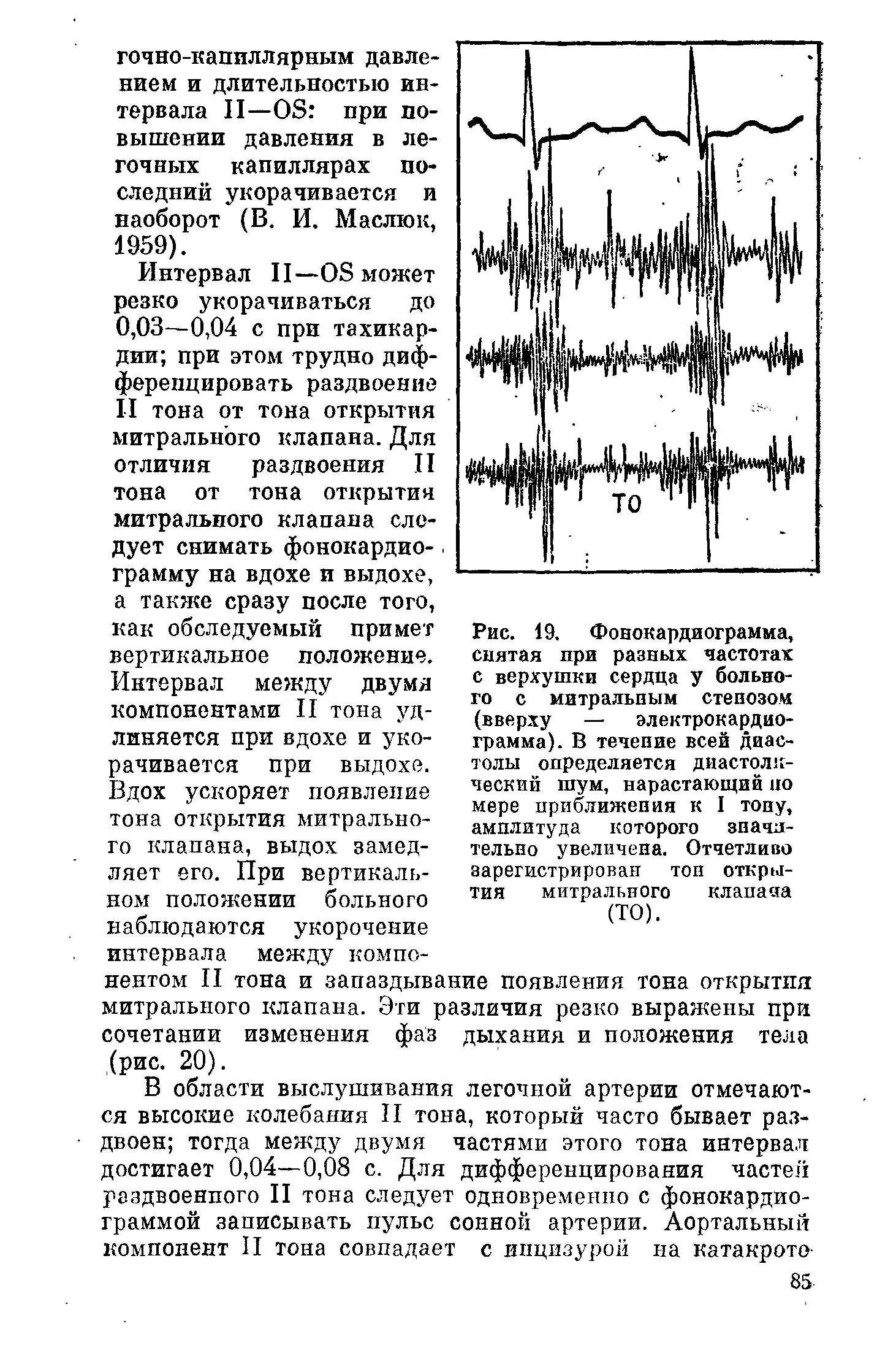 Рис. 19. Фонокардиограмма, снятая при разных частотах с верхушки сердца у больного с митральным стенозом (вверху — электрокардиограмма). В течение всей диастолы определяется диастолический шум, нарастающий по мере приближения к I топу, амплитуда которого значительно увеличена. Отчетливо зарегистрирован тон открытия митрального клапаяа (ТО).