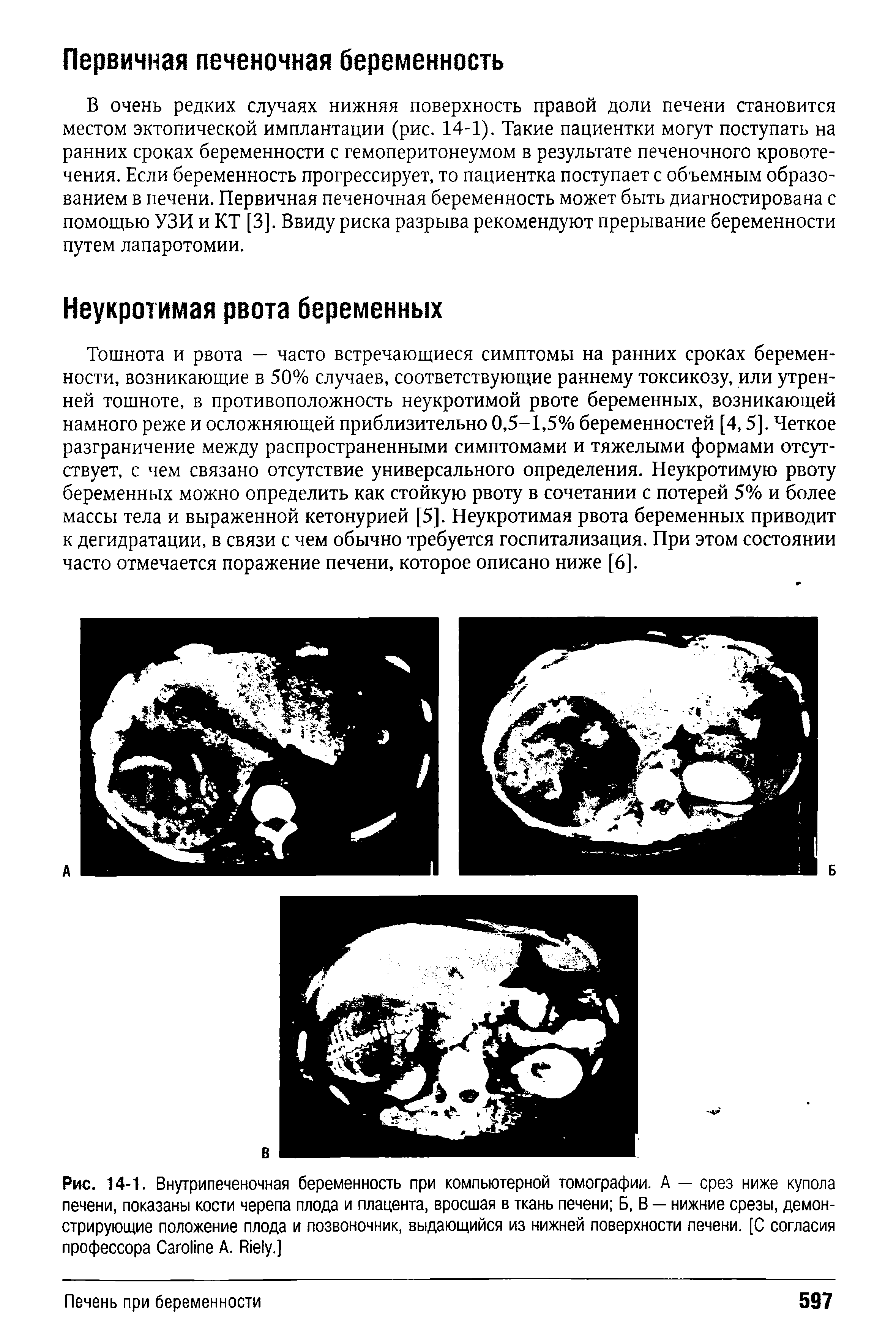 Рис. 14-1. Внутрипеченочная беременность при компьютерной томографии. А — срез ниже купола печени, показаны кости черепа плода и плацента, вросшая в ткань печени Б, В — нижние срезы, демонстрирующие положение плода и позвоночник, выдающийся из нижней поверхности печени. [С согласия профессора C A. R .]...