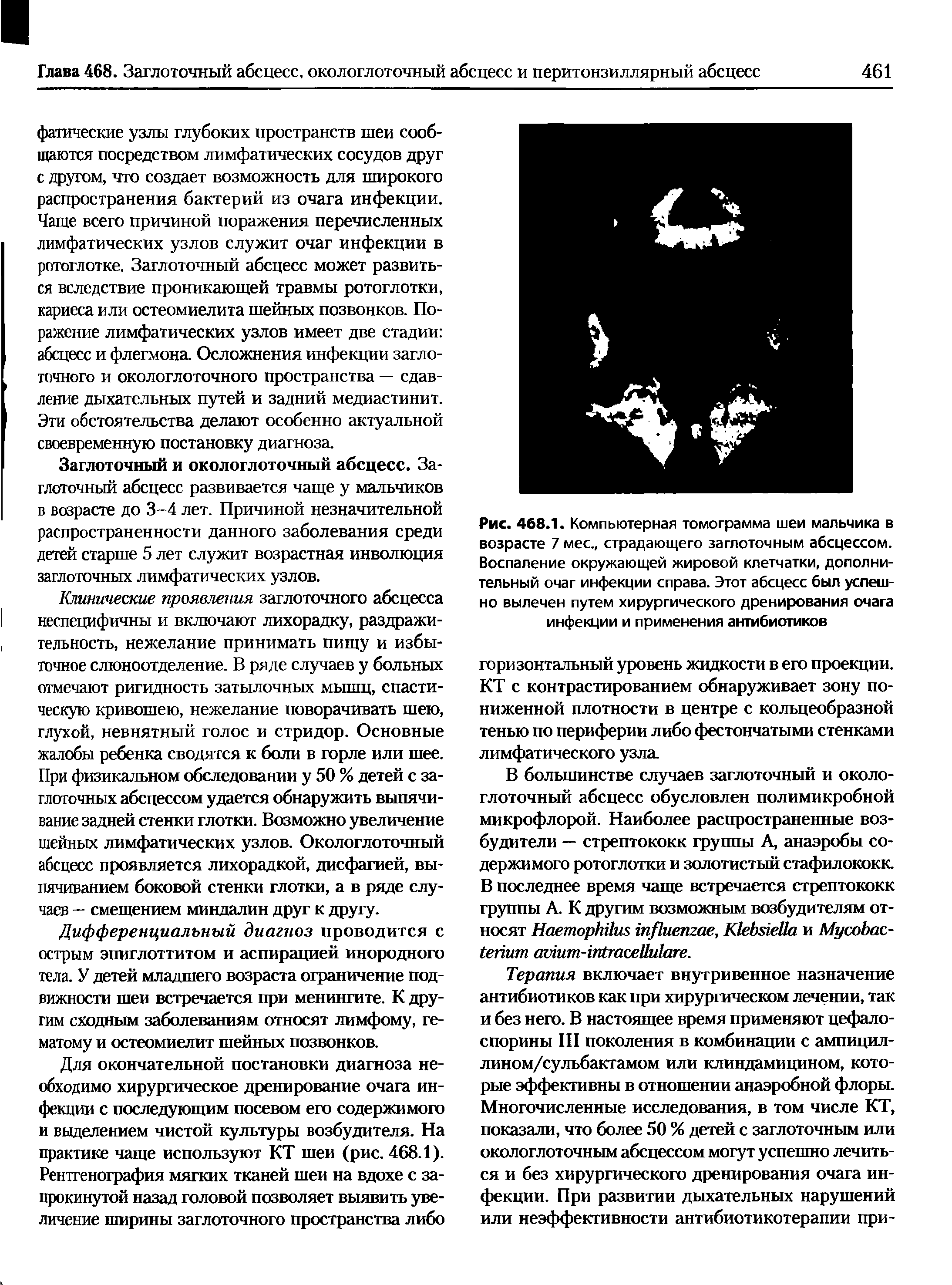 Рис. 468.1. Компьютерная томограмма шеи мальчика в возрасте 7 мес., страдающего заглоточным абсцессом. Воспаление окружающей жировой клетчатки, дополнительный очаг инфекции справа. Этот абсцесс был успешно вылечен путем хирургического дренирования очага инфекции и применения антибиотиков...
