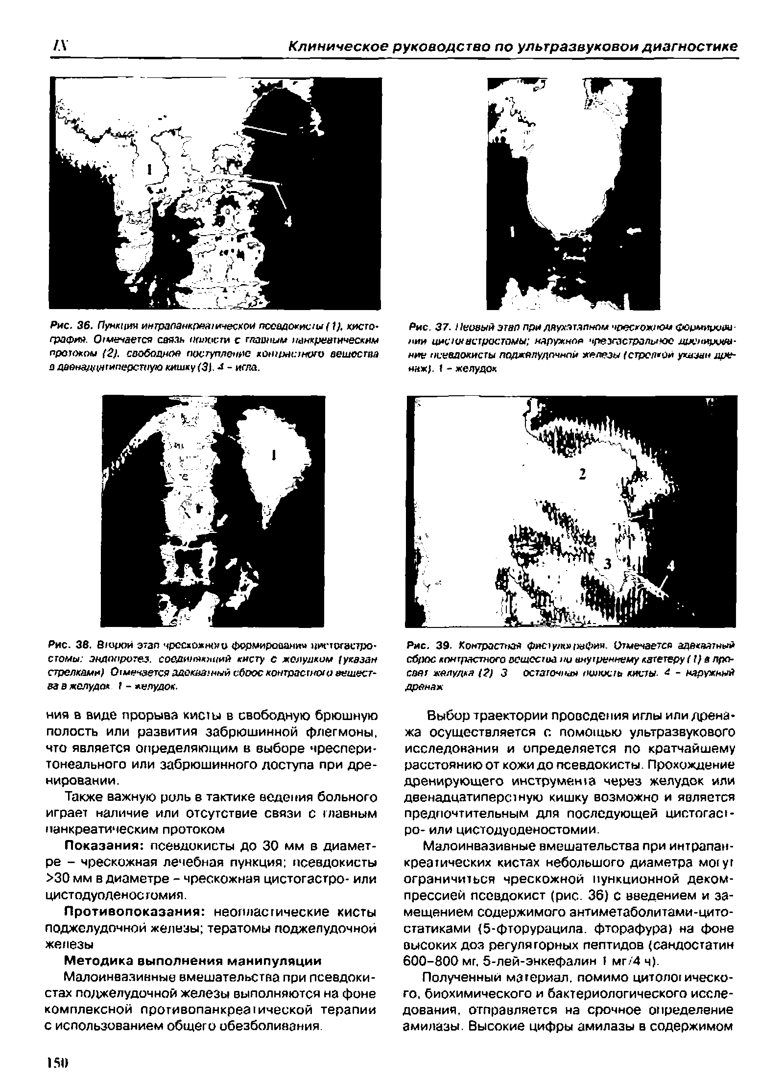 Рис. 37. Неоаый этап при даухэтапнпм чрескожном формными-иии цнсклнстростомы наружное чрезгастралыкж дууимуил -ние псевдокисты поджелудочной железы (стрелкой указан дренаж. I - желудох...