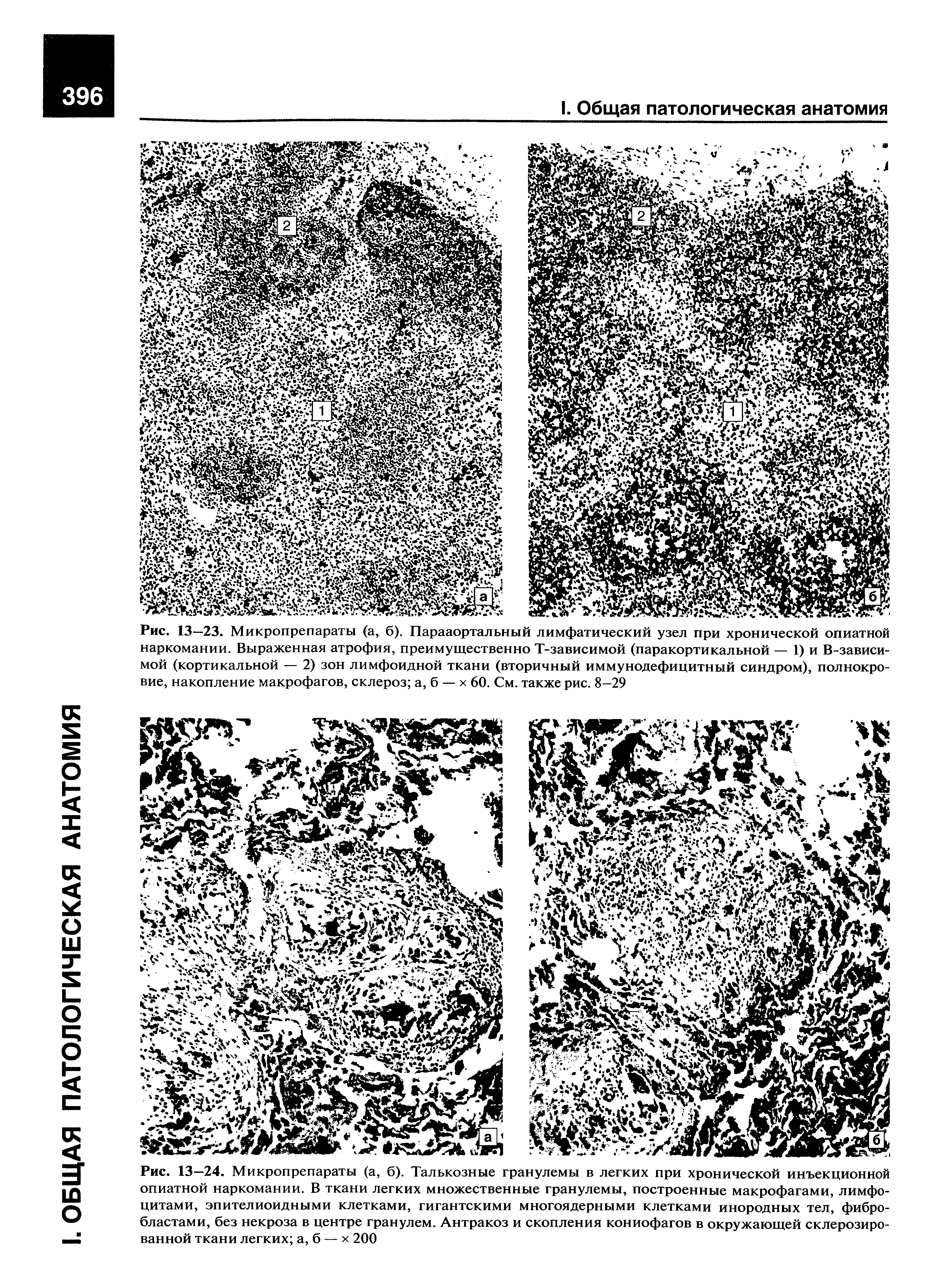 Рис. 13—23. Микропрепараты (а, б). Парааортальный лимфатический узел при хронической опиатной наркомании. Выраженная атрофия, преимущественно Т-зависимой (паракортикальной — 1) и В-зависи-мой (кортикальной — 2) зон лимфоидной ткани (вторичный иммунодефицитный синдром), полнокровие, накопление макрофагов, склероз а, б — х 60. См. также рис. 8—29...