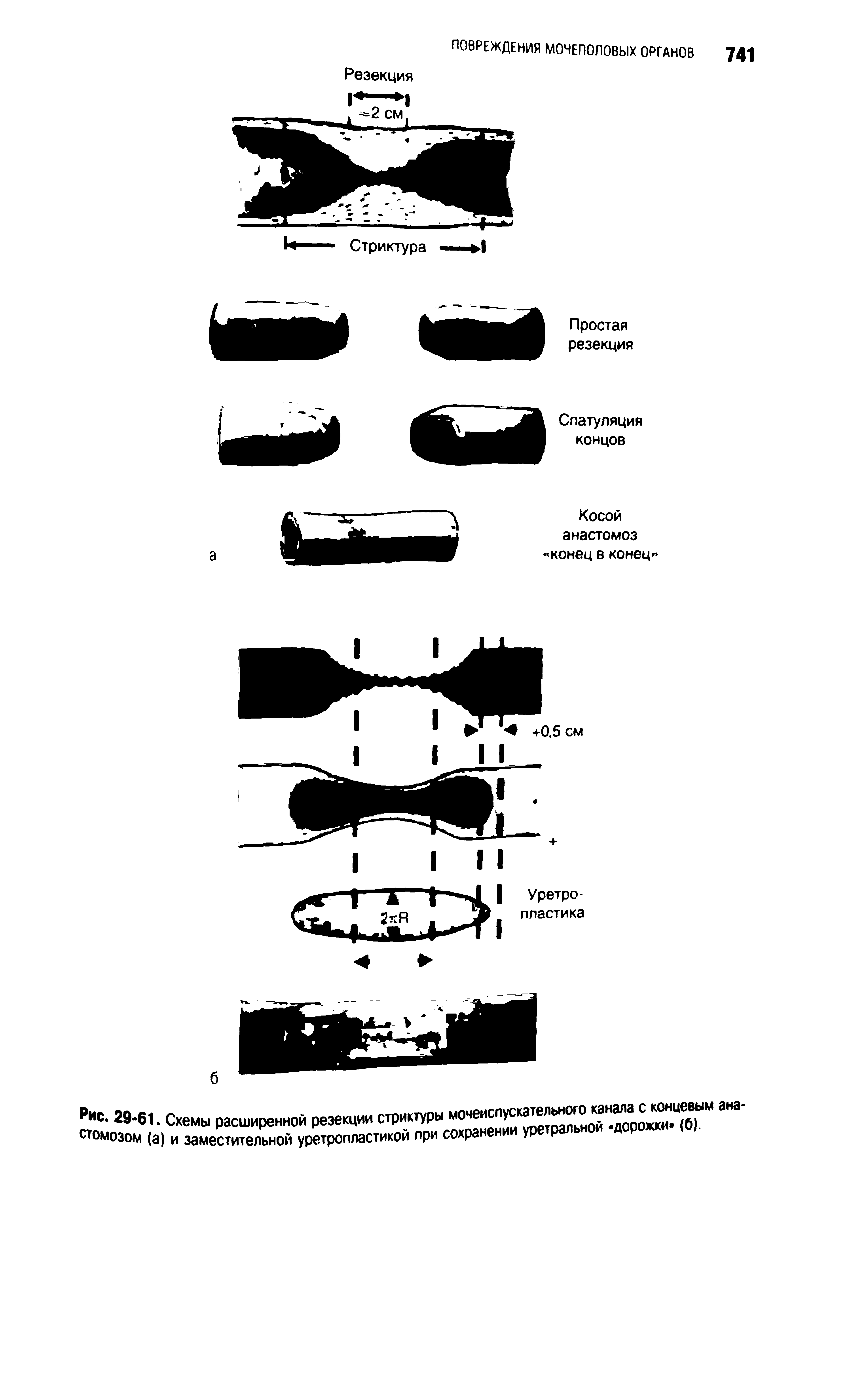 Рис. 29-61. Схемы расширенной резекции стриктуры У уретральной дорожки (б),...
