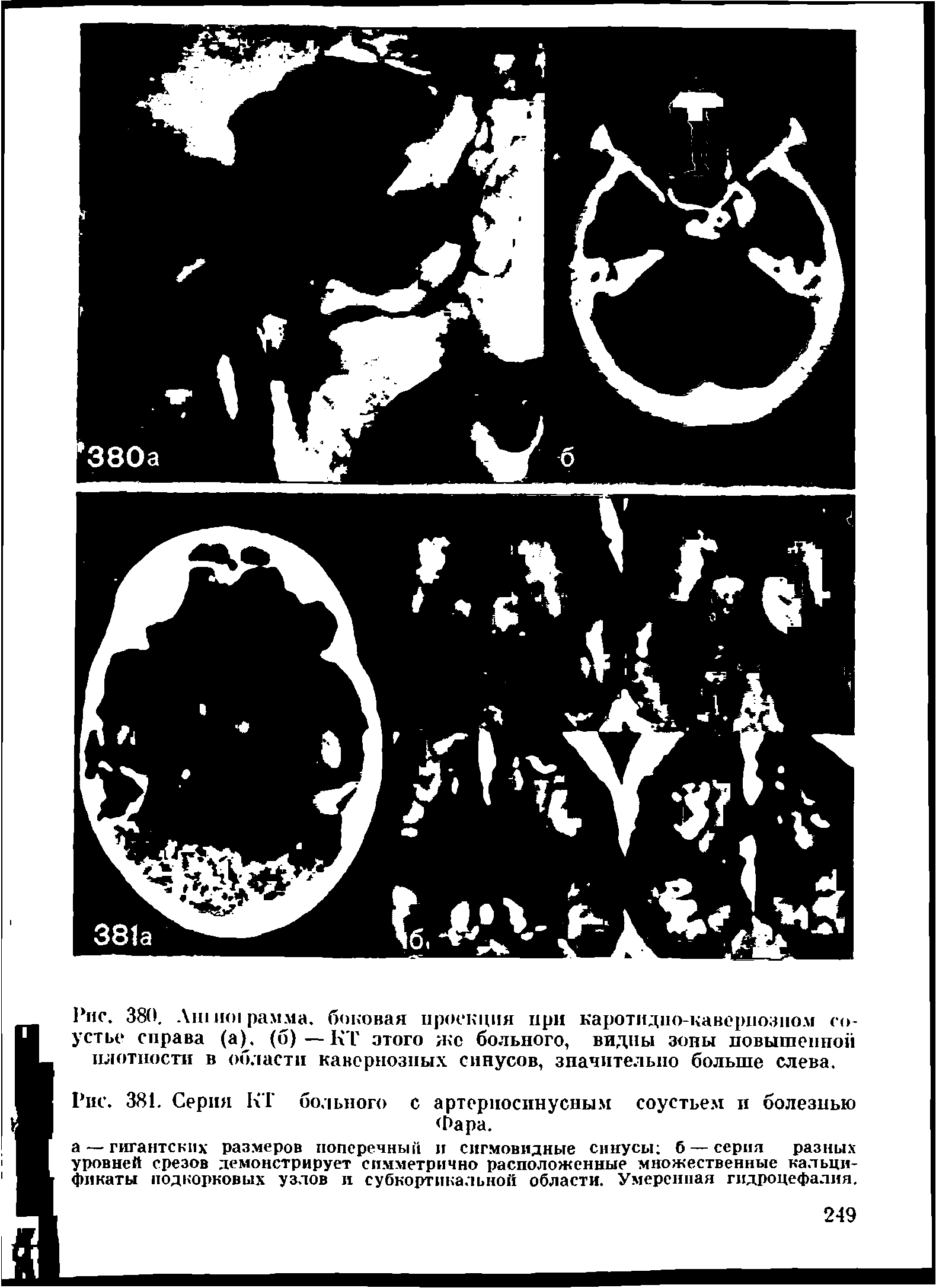 Рис. 381. Серия КТ больного с артериосинусным соустьем и болезнью бара.