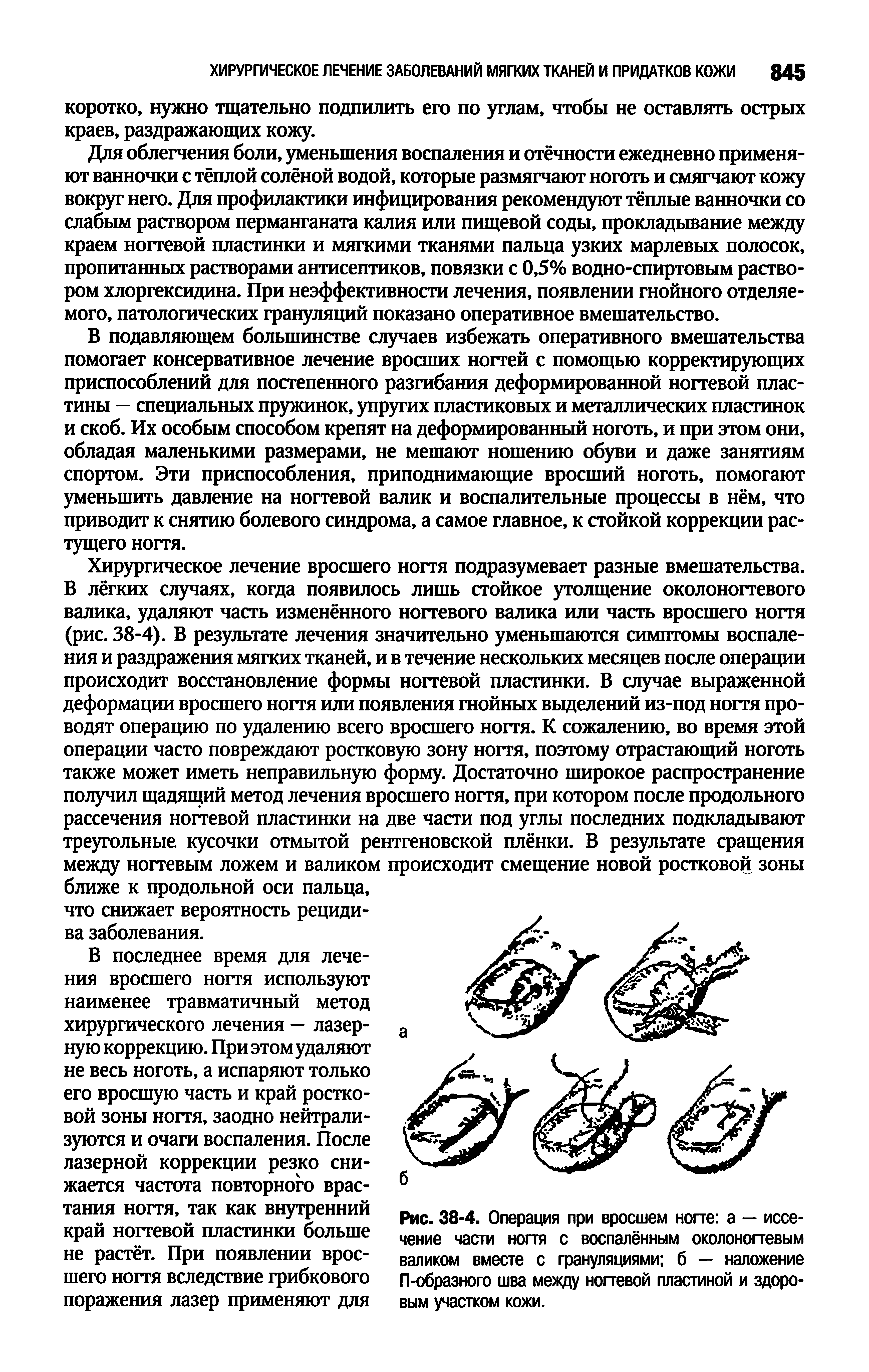 Рис. 38-4. Операция при вросшем ногте а — иссечение части ногтя с воспалённым околоногтевым валиком вместе с грануляциями б — наложение П-образного шва между ногтевой пластиной и здоровым участком кожи.