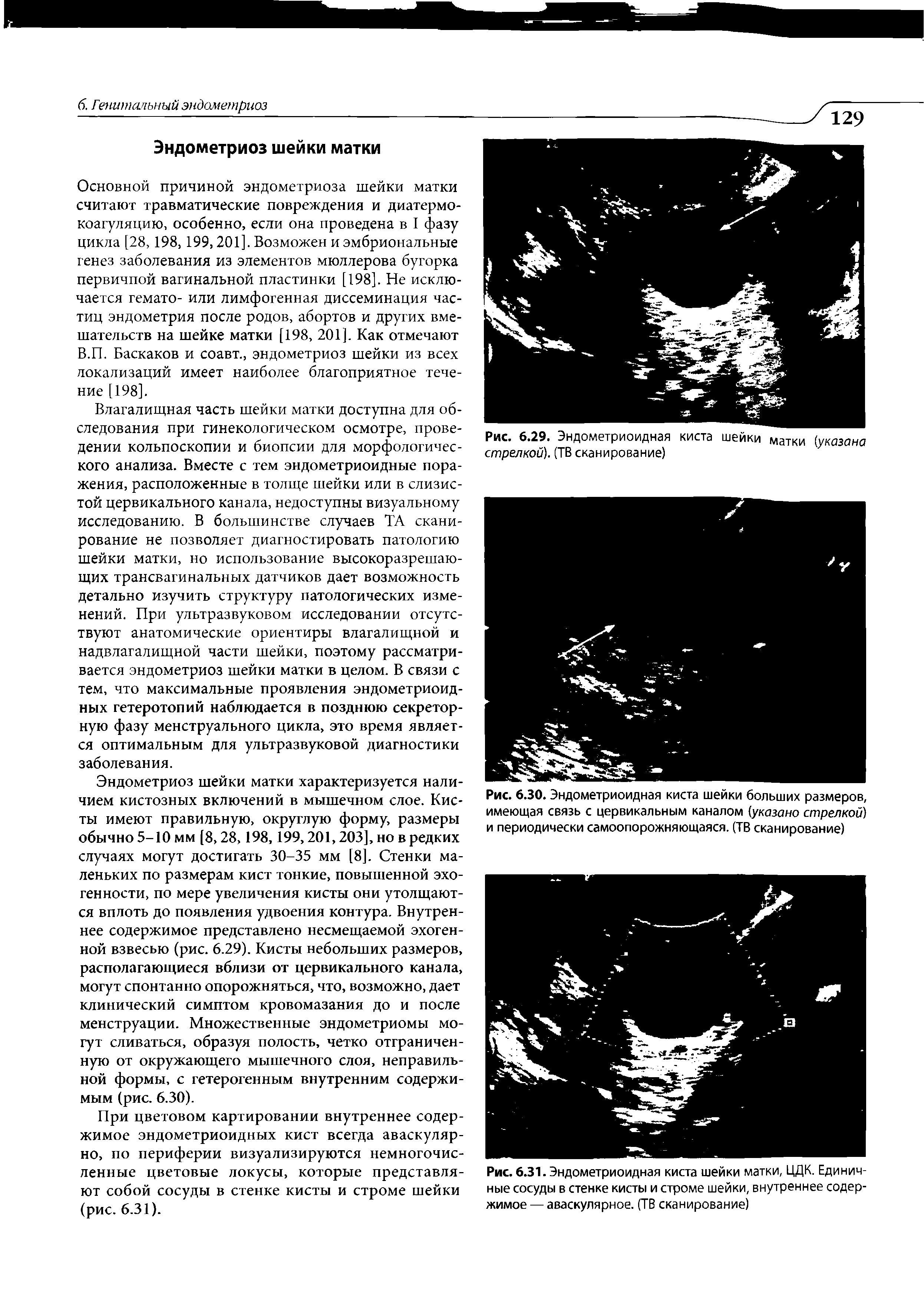 Рис. 6.29. Эндометриоидная киста шейки Матки (указана стрелкой). (ТВ сканирование)...