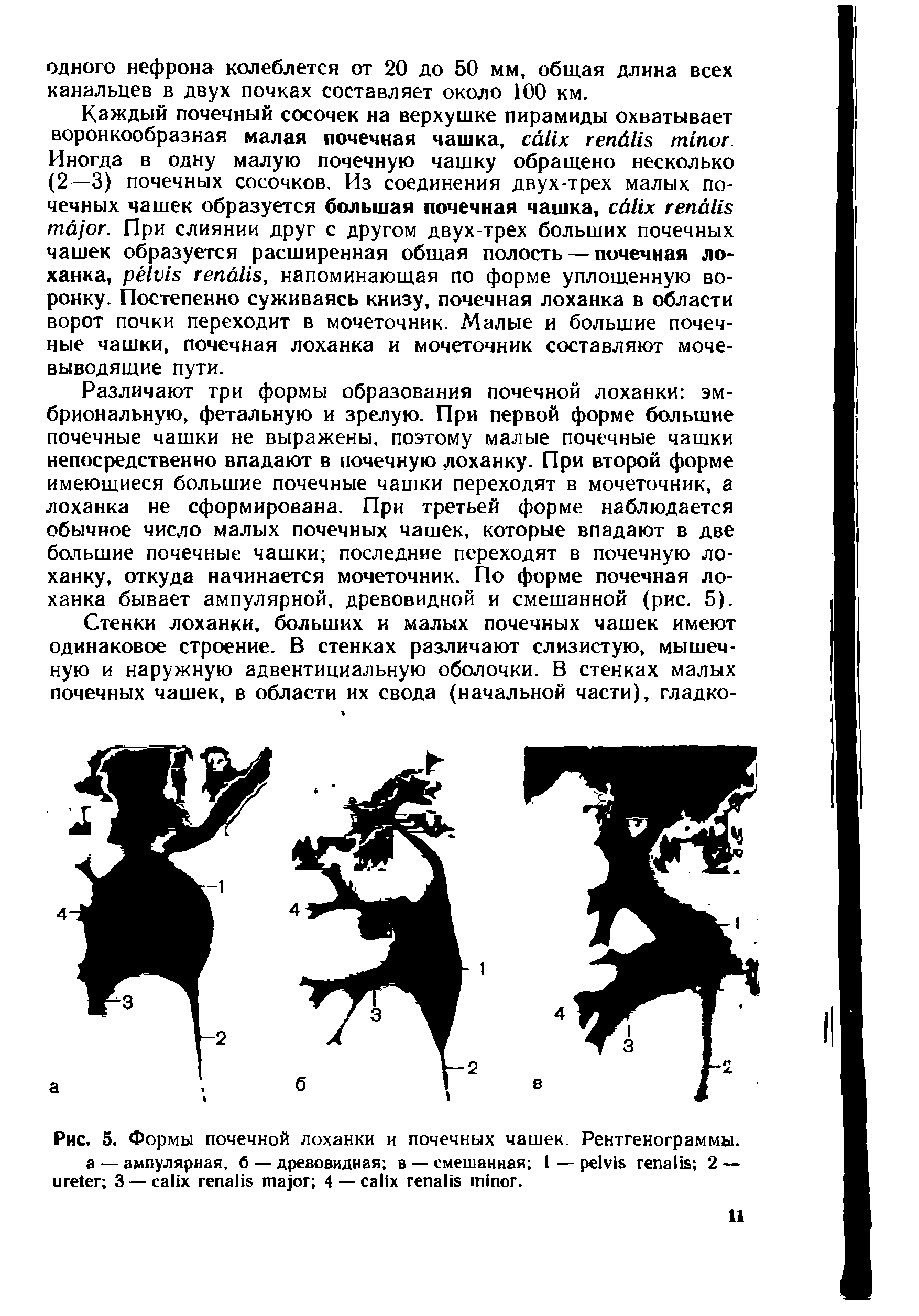 Рис. 5. Формы почечной лоханки и почечных чашек. Рентгенограммы, а — ампулярная, б — древовидная в — смешанная 1— 2 — 3 — 4 — .