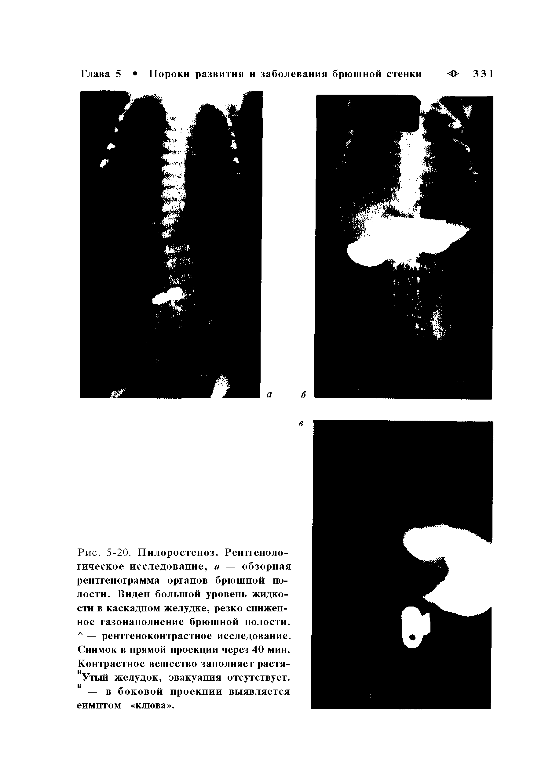 Рис. 5-20. Пилоростеноз. Рентгенологическое исследование, а — обзорная рентгенограмма органов брюшной полости. Виден большой уровень жидкости в каскадном желудке, резко сниженное газонаполнение брюшной полости. л — рентгеноконтрастное исследование. Снимок в прямой проекции через 40 мин. Контрастное вещество заполняет растя-нУтый желудок, эвакуация отсутствует, в ...