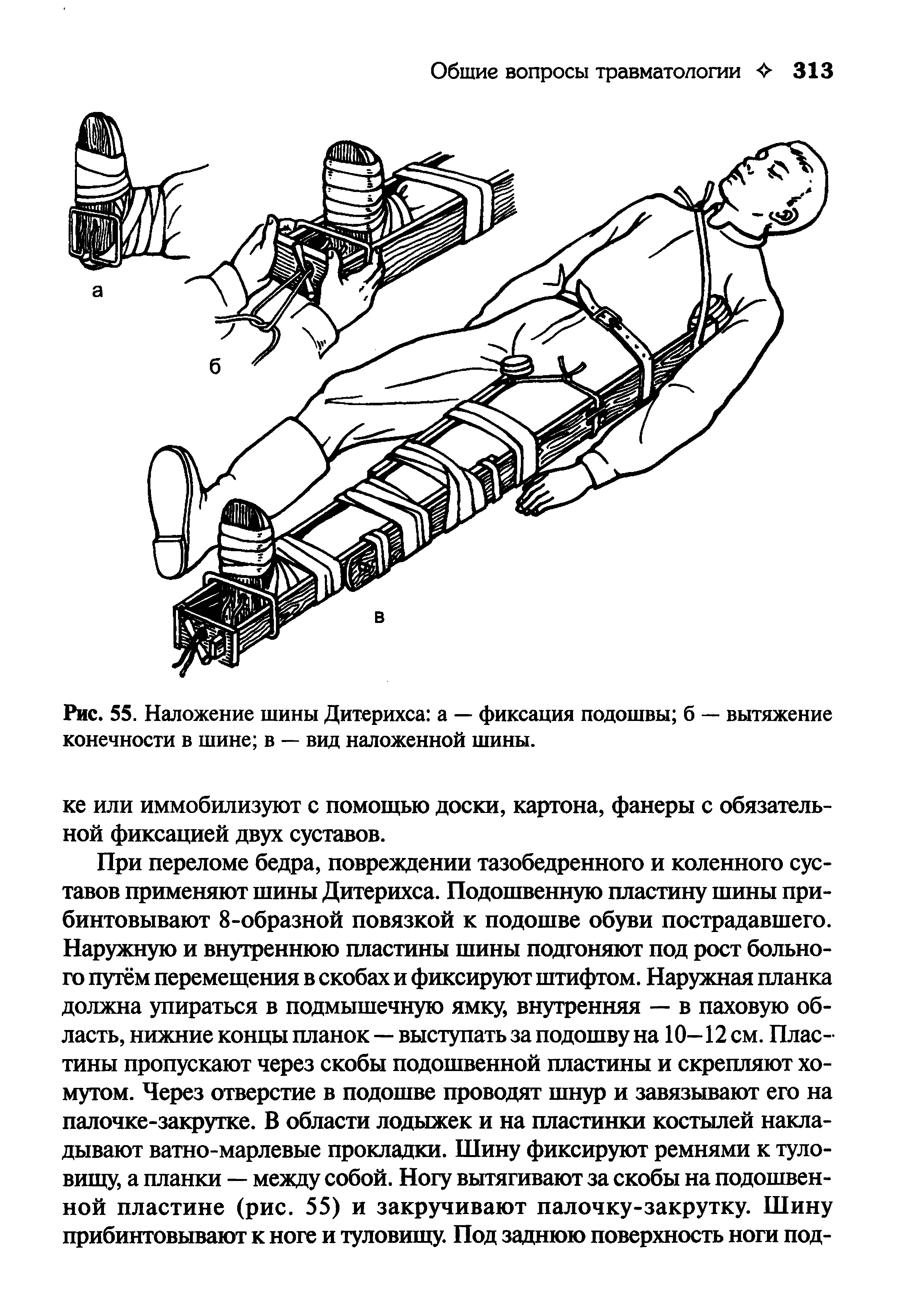 Рис. 55. Наложение шины Дитерихса а — фиксация подошвы б — вытяжение конечности в шине в — вид наложенной шины.