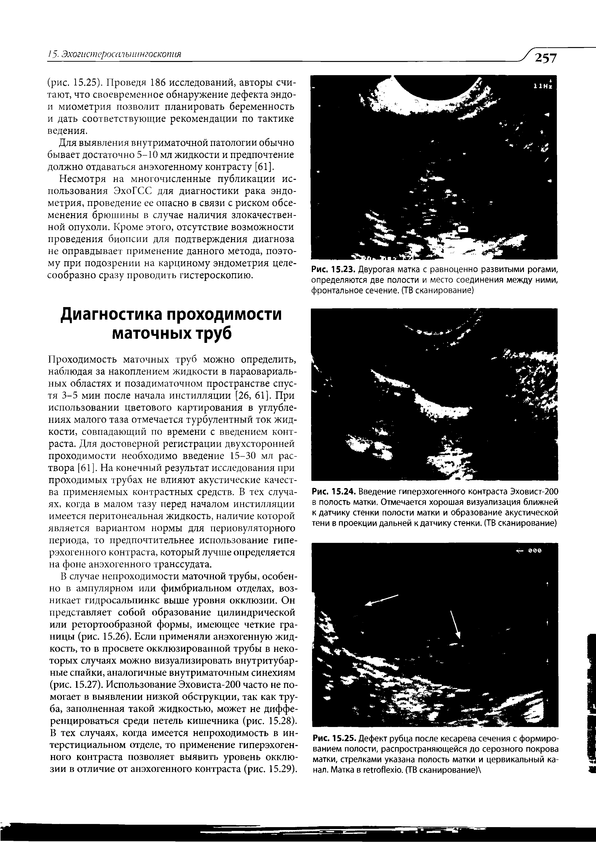 Рис. 15.25. Дефект рубца после кесарева сечения с формированием полости, распространяющейся до серозного покрова матки, стрелками указана полость матки и цервикальный канал. Матка в гепоАехю. (ТВ сканирование) ...