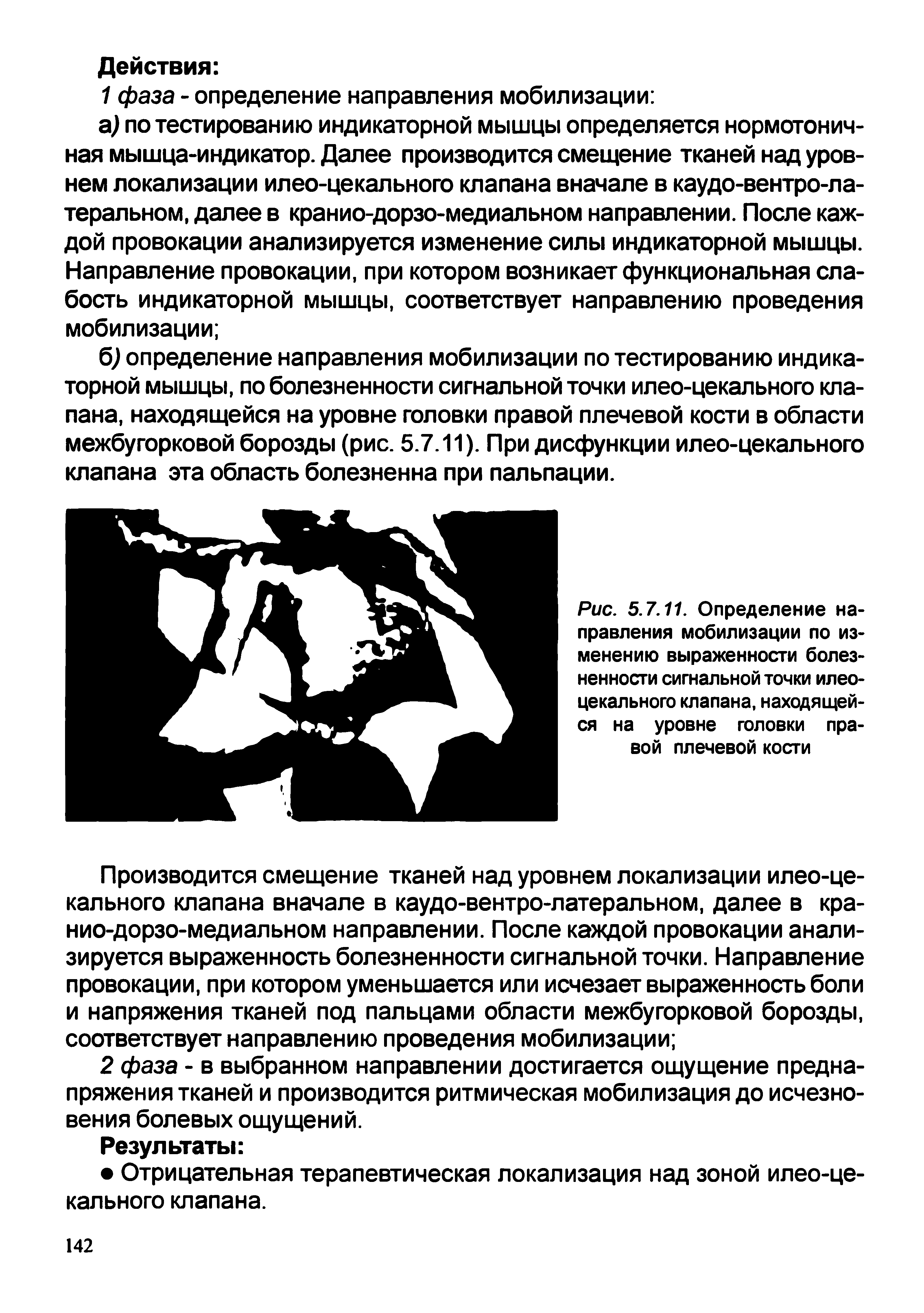 Рис. 5.7.11. Определение направления мобилизации по изменению выраженности болезненности сигнальной точки илеоцекального клапана, находящейся на уровне головки правой плечевой кости...