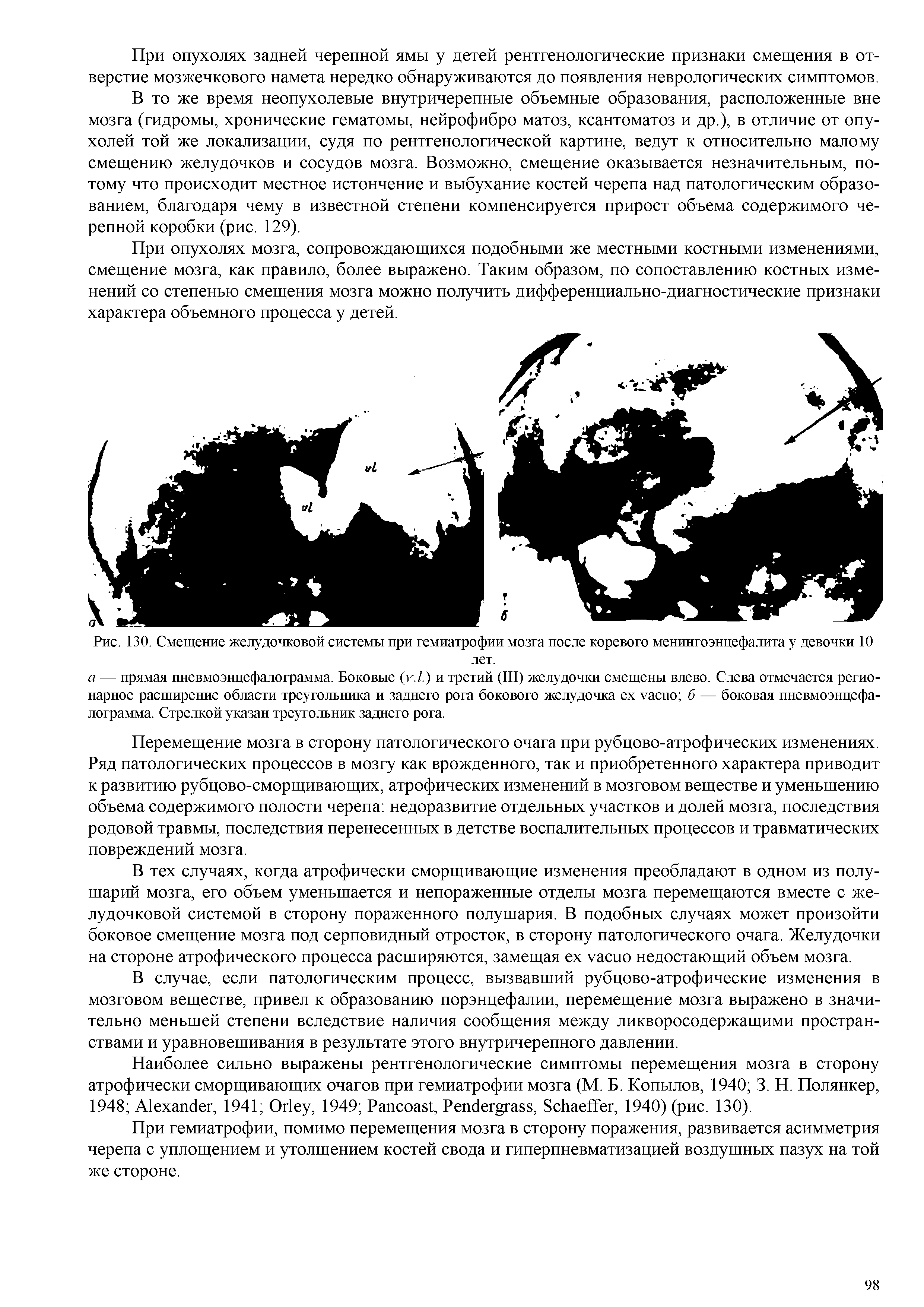 Рис. 130. Смещение желудочковой системы при гемиатрофии мозга после коревого менингоэнцефалита у девочки 10 лет.