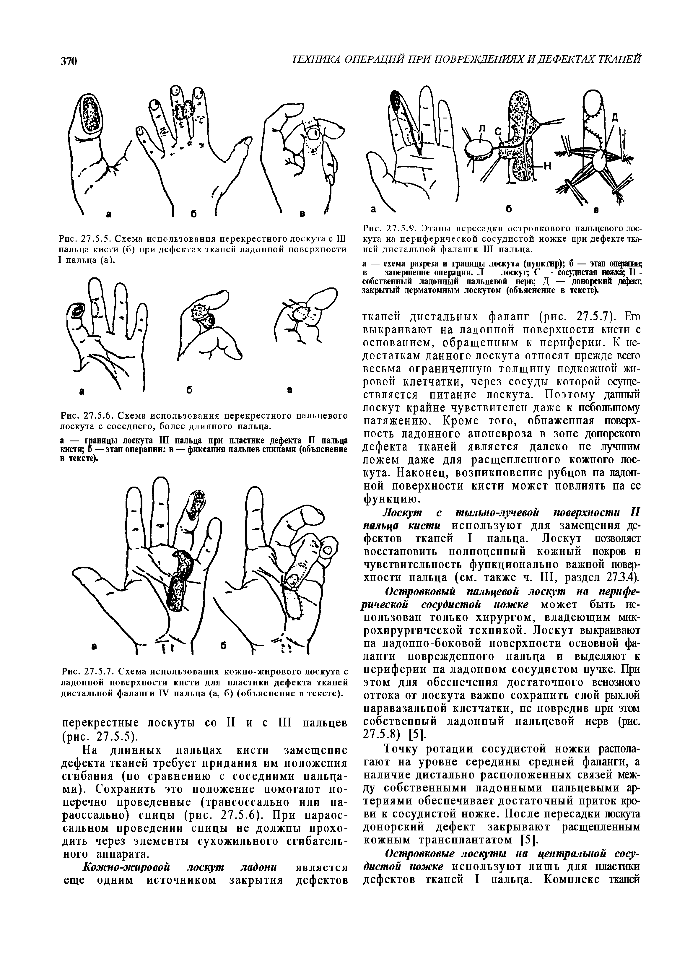 Рис. 27.5.9. Этапы пересадки островкового пальцевого лоскута на периферической сосудистой ножке при дефекте тканей дистальной фаланги III пальца.