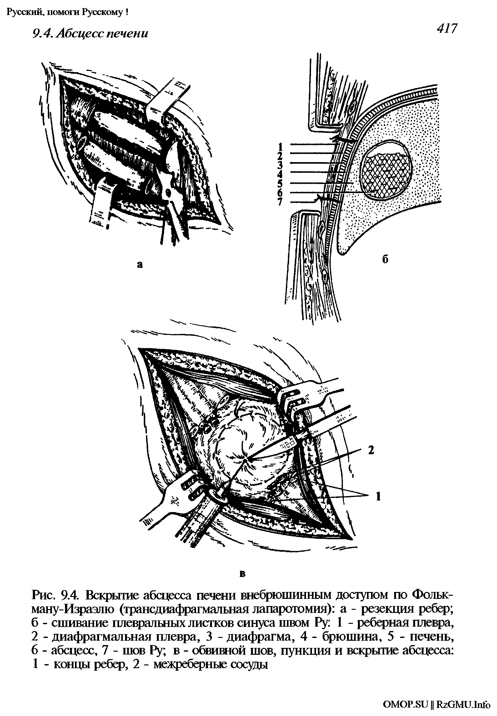 Рис. 9.4. Вскрытие абсцесса печени внебрюшинным доступом по Фольк-ману-Израэлю (трансдиафрагмальная лапаротомия) а - резекция ребер б - сшивание плевральных листков синуса швом Ру 1 - реберная плевра, 2 - диафрагмальная плевра, 3 - диафрагма, 4 - брюшина, 5 - печень, 6 - абсцесс, 7 - шов Ру в - обвивной шов, пункция и вскрытие абсцесса 1 - концы ребер, 2 - межреберные сосуды...
