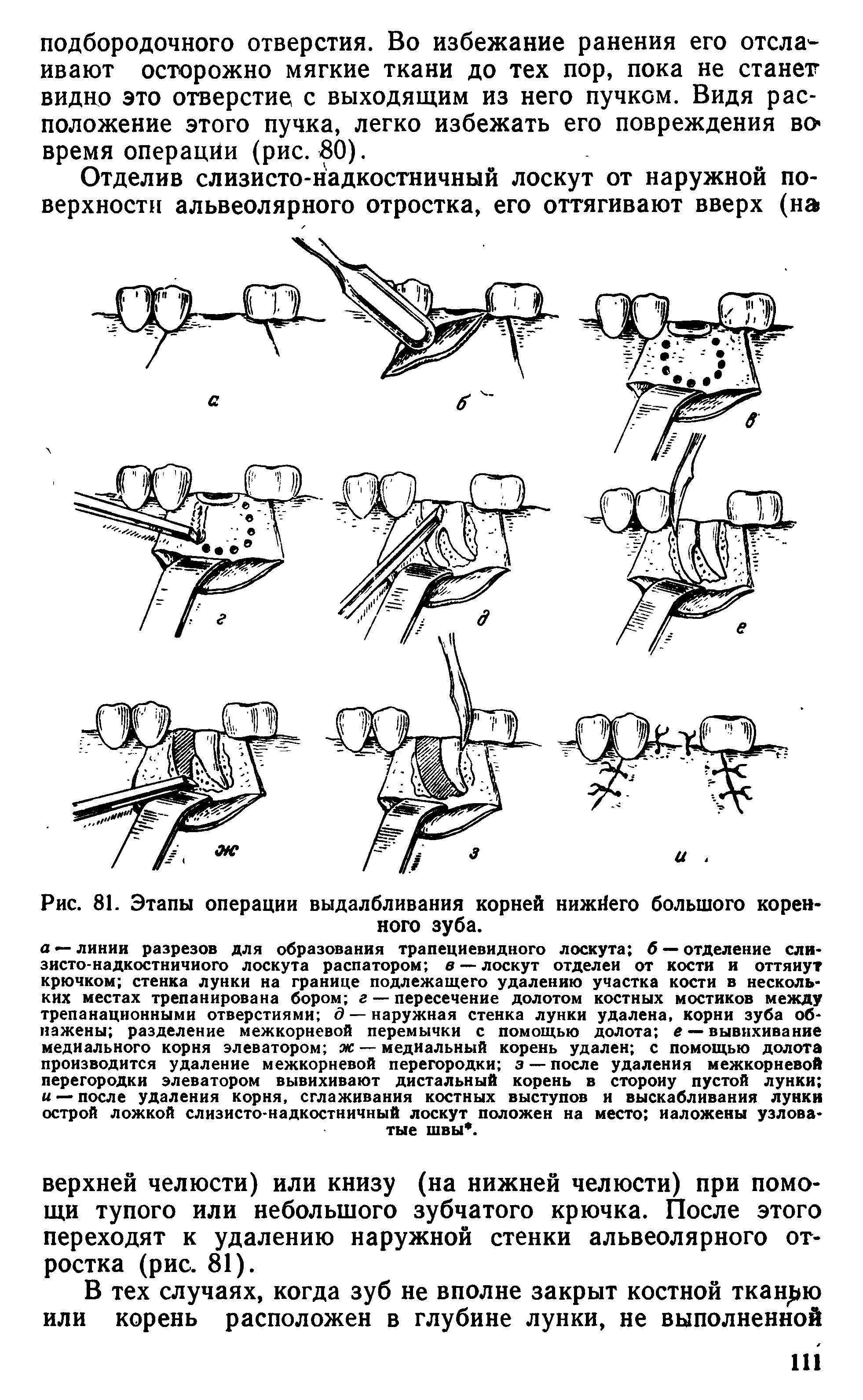 Рис. 81. Этапы операции выдалбливания корней нижйего большого коренного зуба.