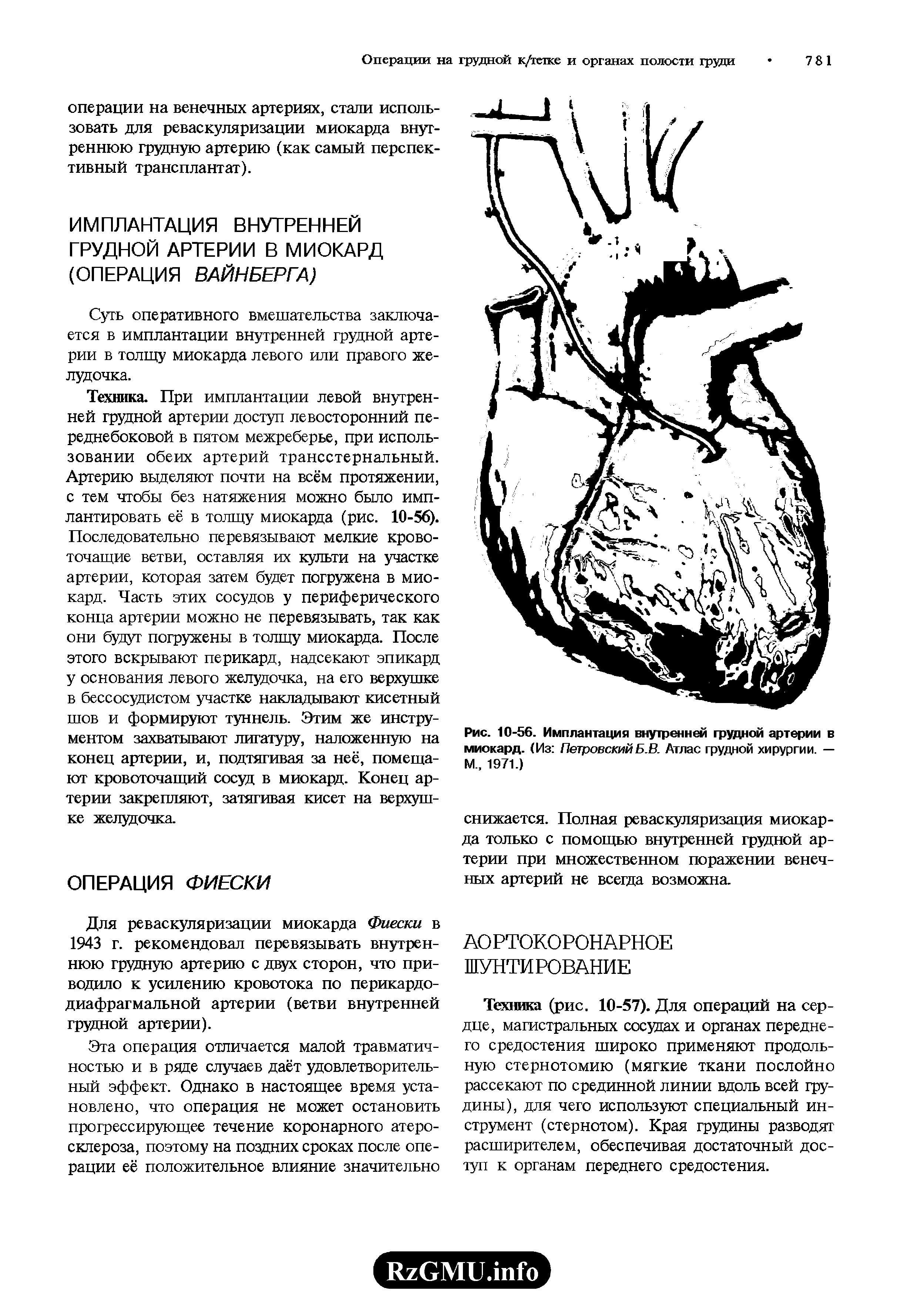 Рис. 10-56. Имплантация внутренней грудной артерии в миокард. (Из Петровский Б.В. Атлас грудной хирургии. — М 1971.)...