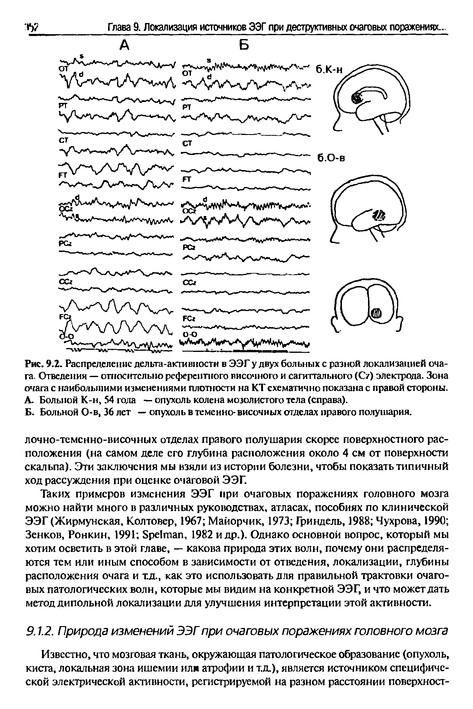 Рис. 9.2. Распределение дельта-активности в ЭЭГ у двух больных с разной локализацией очага. Отведения — относительно референтного височного и сагиттального (С ) электрода. Зона очага с наибольшими изменениями плотности на КТ схематично показана с правой стороны. А. Больной К-н, 54 года — опухоль колена мозолистого тела (справа).