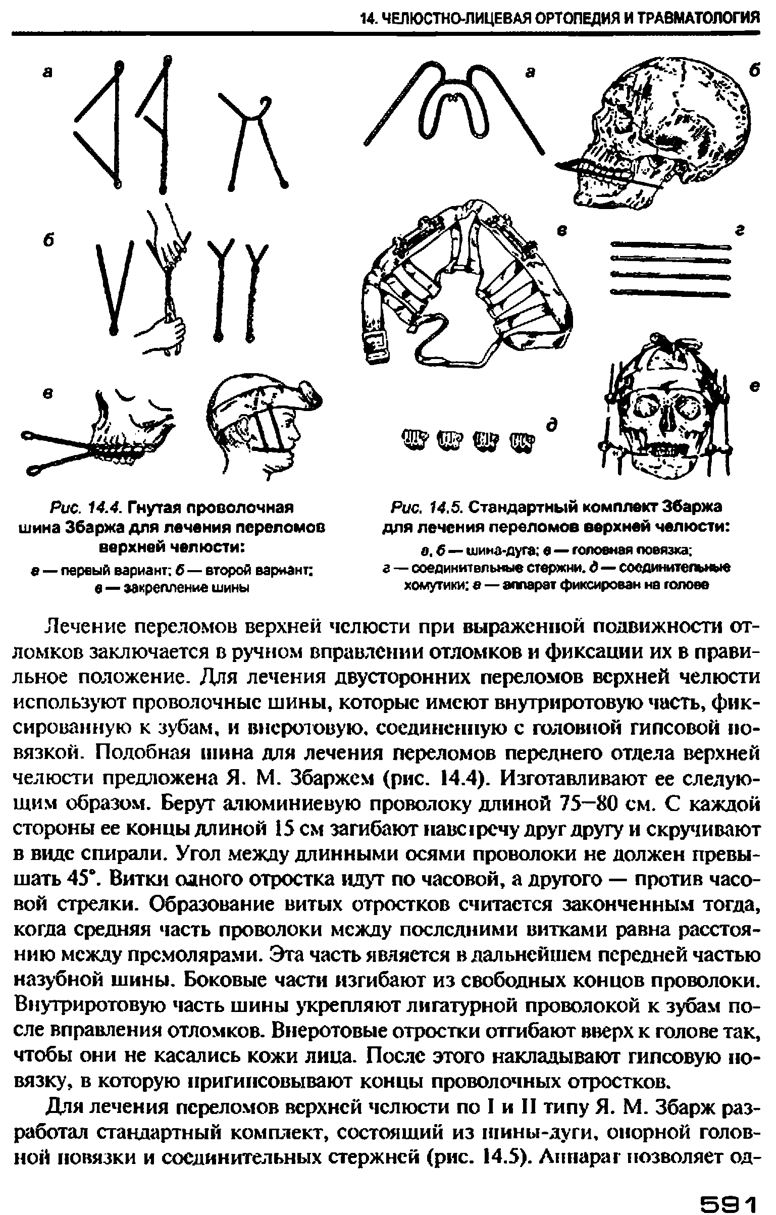 Рис. 14.4. Гнутая проволочная шина Збаржа для лечения переломов верхней челюсти ...