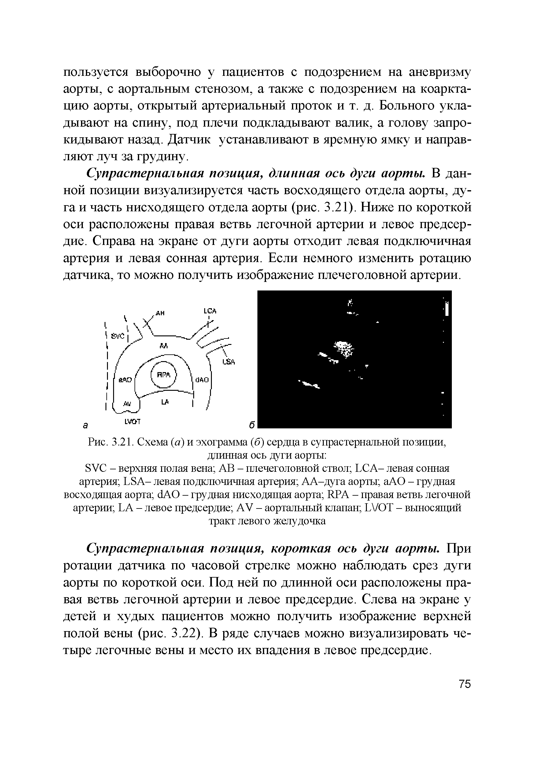 Рис. 3.21. Схема (а) и эхограмма (б) сердца в супрастернальной позиции, длинная ось дуги аорты ...