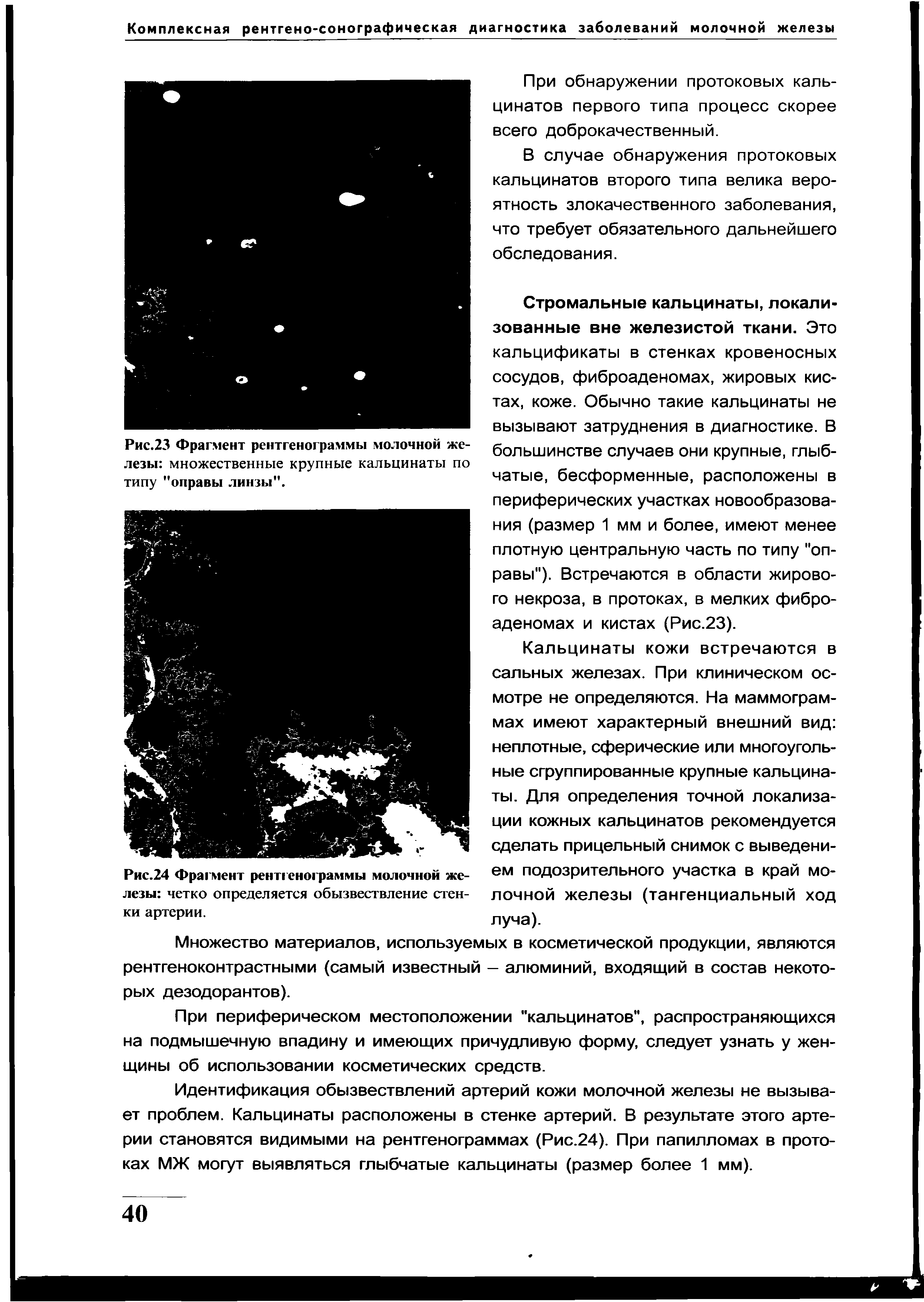 Рис.24 Фрагмент рентгенограммы молочной железы четко определяется обызвествление стенки артерии.